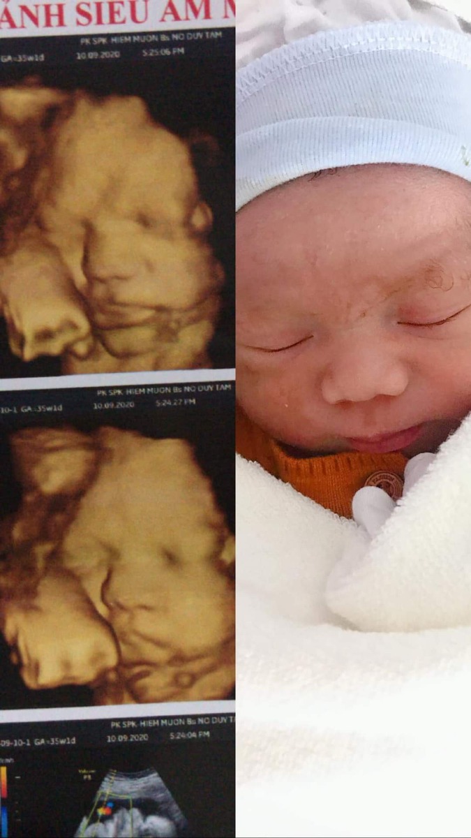Con là chuột trai . Mới 37w4d mà hôm qua còn đã đòi ra rồi . Chiều hôm qua mẹ con nhập viện lúc 2h chiều vì có dấu hiệu sinh lúc 10h sáng là ra nhiều dịch nhầy với máu báo hồng . con đã được bsi đưa ra rùiii 😆 trộm vía con ngoan ko quấy khóc nhiều 
Con nặng 3kg1 mẹ con cố gắng rặn sinh thường ra con ạ ❤️ !! Các mom mát miệng chúc con nhé !! Chúc các mom nhanh chuyển dạ dễ sinh ko đau đớn giống em nha 😍😍