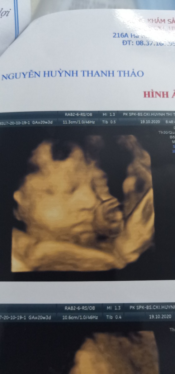 Có mom nào thíc nằm bên phải giống e k ạ..ngta nói k tốt nhưng ngủ nghiêng phải e thấy thoải mái hơn nay e 33w r ah