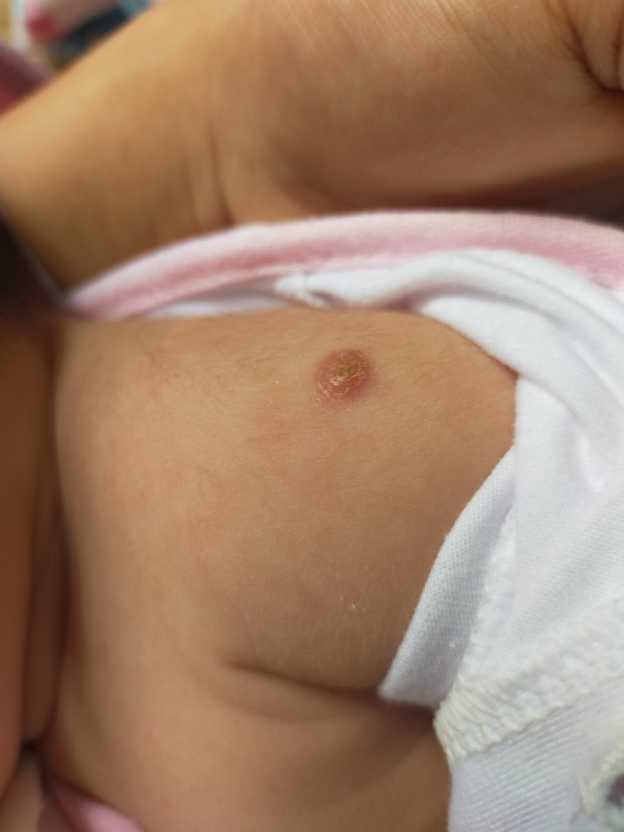 chuột nhà em 1tháng5day chổ chích ngừa có rỉ mủ không biết có sao không các mom, em tập đầu nên hoang mang