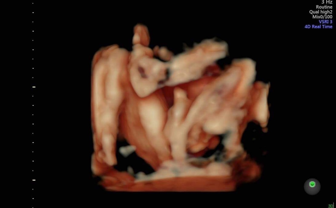 Bé nhà em 24w2d đc 753 gram . 
Còn các bé nhà các mom bn gram r ạ 
Chia sẻ để biết con mình đang phát tiển ntn đi ạ