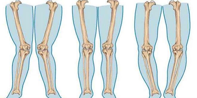 TRẺ ĐỨNG SỚM BỊ CÒNG CHÂN

🔰Đứng sớm là gì?
🔸6 – 10 tháng: đa số các trẻ bắt đầu học cách vịn đồ vật, và kéo thân mình lên vào tư thế đứng.
🔸7 – 13 tháng: đa số trẻ sẽ bắt đầu biết vịn lần lần để di chuyển bản thân. Cũng trong thời gian này, một số trẻ cũng có thể đi được với sự hỗ trợ của người lớn (nhưng bạn không nên bắt trẻ tập đi một mình nhé, lý do sẽ có ở phần sau)
🔸11 – 14 tháng: đa số trẻ sẽ bắt đầu đi được một mình

❓Còng chân là gì?❓Có đáng lo hay không❓
👉Còng chân sinh lý
Còng chân, hay chân vòng kiềng, là một hiện tượng khi trẻ đứng thẳng, hai chân chụm lại, ngón chân cái hướng ra phía trước, thì mắc cá chân hai bên chạm vô nhau, nhưng đầu gối hai bên cách xa nhau. Bạn có biết rằng, còng chân (bow legs) là MỘT PHÁT TRIỂN BÌNH THƯỜNG của hệ cơ xương của trẻ nhũ nhi.
👉Còng chân bệnh lý, chiếm khoảng dưới 1% các trường hợp còng chân ở trẻ dưới 2 tuổi. Có hai loại còng chân bệnh lý mà chúng ta cần biết, vì phổ biến nhất:
✍️Bệnh Blount
Bệnh Blount ở trẻ nhũ nhi: đây là một còng chân bệnh lý, bất thường phát triển xương cẳng chân, xảy ra trong quá trình phát triển của trẻ. Người ta thấy rằng bệnh này thường xảy ra ở những trẻ (thường bị thừa cân) tự đi một mình sớm trước 12 tháng tuổi, một số trường hợp có yếu tố di truyền.
✍️Bệnh còi xương
Bệnh còi xương do thiếu vitamin D, gây xương mềm, yếu, dễ biến dạng khi chịu trọng lực của trẻ. Ở các thế hệ trước, bệnh này khá thường gặp. Ở thời đại ngày nay, bệnh này rất hiếm gặp. Khuyến cáo hiện nay là mẹ cho con bú mẹ hoàn toàn, nên bổ sung vitamin D 400IU một ngày cho con, cho đến khi con được 1 tuổi. Nếu trẻ bú sữa công thức hoàn toàn, trẻ không cần bổ sung thêm vitamin D. Khi được bổ sung đúng và đủ vitamin D, chúng ta có thể tránh nguy cơ bệnh còi xương ở trẻ.

👨🏼‍⚕️Vậy cho nên, thật sự là, con bạn đứng “sớm” không đồng nghĩa với nguy cơ bị còng chân, mà chỉ là làm rõ hơn sự còng chân sinh lý của trẻ mà thôi. Trẻ thừa cân tự đi sớm trước 12 tháng, có thể có nguy cơ phát triển còng chân bệnh lý, vì vậy cho nên, không nên ép con trẻ tập đi một mình quá sớm, và nếu bé có đi trong giai đoạn trước sinh nhật 1 tuổi, nên được người lớn hỗ trợ để không tạo áp lực trọng lực quá nhiều đối với xương cẳng chân của trẻ.

👨🏼‍⚕️Khi nào cho trẻ đi khám bác sĩ
🔹Trẻ bị còng chân rất nặng
🔹Trẻ được hơn 3 tuổi và vẫn còn bị còng chân
🔹Trẻ sau 8 tuổi bị khuỳnh gối nặng hơn
🔹Trẻ chỉ bị còng chân 1 bên mà thôi
🔹Trẻ bị đau, hoặc khập khiễng khi đi.
🔹Trẻ có chiều cao thấp bất thường so với tuổi (theo biểu đồ tăng trưởng)