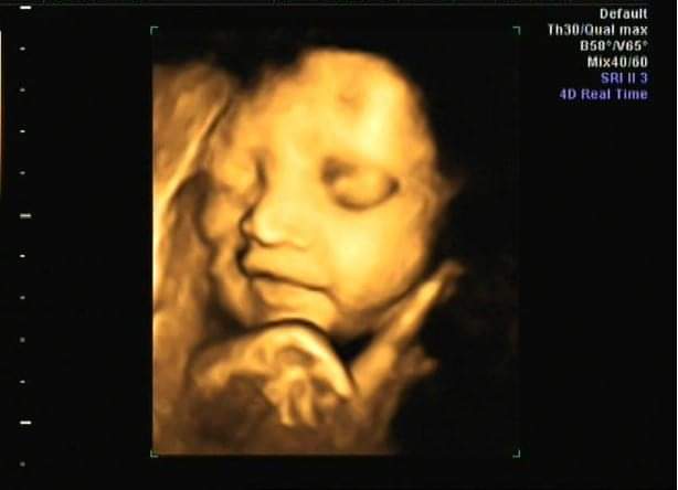 Cho e tâm sự cùng các chị e chút nha. Mong là hành trình tìm con của e sẽ giúp đỡ các mom phần nào có thêm động lực. 5 năm rồi e có mỗi điều ước đơn giản thôi là một lần được làm mẹ, được nghén như bạn bè, các chị e họ hàng. Suốt 5 năm e cứ khóc cứ trách sao điều ước của mình đơn giản vậy sao mãi ko thành hiện thực. E cũng là phụ nữ mà sao lại chẳng được như mọi người. E đi khám bác sĩ bảo AMH của e 1,08 quá thấp so với tuổi phải làm ivf mới có cơ hội.

E lại là giáo viên mầm non nữa, mỗi ngày đến gặp các con e vừa vui nhưng buồn thì nhiều hơn. E rất rất yêu trẻ con nữa. Mọi chuyện buồn, lời chê này chê nọ e đều cố gắng bỏ qua hết. Chỉ mong đến giờ đi làm để gặp các con cho quên đi hết mọi chuyện, e chỉ muốn mỗi lúc e đến lớp tất cả tình thương chân thành e sẽ dành cho các con.

E đi khám bác sĩ bảo AMH của e 1,08 quá thấp so với tuổi phải làm ivf mới có cơ hội. Lương chẳng được nhiều ck e cũng làm lái xe, để ra bao nhiêu là thuốc thang cũng hết nên 2 vk ck tính khi nào có đủ thì làm. Mà e toàn đi cắt thuốc ở các chỗ có người quen uống hiệu quả, sao e thì lại chẳng thấy thay đổi gì cả. Đổi lại chỉ thấy gầy đi. Tiền cứ tháng nào hết tháng đấy, quần áo chẳng giám mua sắm, bạn bè người thân ai cũng hỏi han. E ko dám kể, e ko muốn ck e phải lo lắng thêm vì ck e cũng chịu nhiều áp lực từ đằng nhà ck rồi. E ngày nào cũng chỉ ước mỗi điều vậy thôi, mong con sớm về, bữa cơm sẽ ko chỉ có mỗi 2 vk ck nữa, mỗi lần ck về sẽ có 2 mẹ con ra đón. Trong đầu e lúc nào cũng tưởng tưởng ra vậy, đơn giản mà sao khó quá. Ăn tết năm 2019 xong thì vk ck e đi làm iui trước, do kinh phí làm ivf chưa đủ với nghĩ biết đâu sẽ may mắn. Nhưng may mắn ngủ quên với e thật 🙂 

Đến hè e tranh thủ được nghỉ đi làm ivf, e chỉ chọc được 7 trứng thì có mỗi 2 phôi đạt. Mấy chị đi cùng ai cũng 5, 6 phôi, có chị còn 12 phôi lại thấy hoang mang hơn. Hì may mắn vẫn còn đang ngủ quên. E lại tự an ủi, e vẫn còn có động lực là ck và cả đàn con ở lớp nữa cơ mà. Vậy đấy, 4 năm lại quay về vạch xuất phát. Nhưng lần này e ko còn như 4 năm trước nữa, e mạnh mẽ hơn nhiều và học hỏi kinh nghiệm các chị nhiều hơn. E chăm sóc lại cho 2 vk ck từ bữa ăn đến nước uống, e thoải mái hơn rất nhiều từ khi e dc bác sĩ có tâm tặng 1 câu “cứ cố gắng bằng tất cả những gì có thể, e sẽ có những thứ e đáng được nhận”. 

Khoe với mọi người thành quả sau 1 năm vk ck e cố gắng lại từ đầu đây. E cầu chúc cho tất cả những chị cũng đang trong hoàn cảnh như e sẽ sớm may mắn, chỉ cần cố gắng hết sức có thể. Vì mọi chuyện đều đã được an bài rồi. E viết dài quá mong chị e thông cảm nha