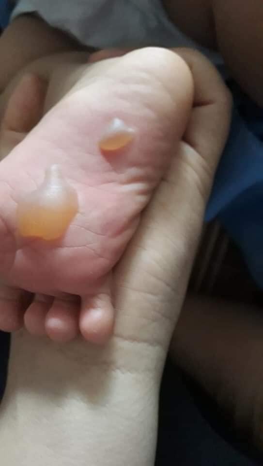 Đừng mẹ nào thấy con ho mà giã tỏi quấn chân nhé
Hậu quả vô cùng nặng nề đấy ạ