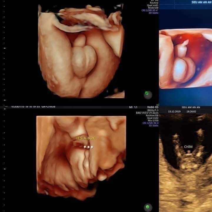 CÁC MỐC KHÁM THAI QUAN TRỌNG:
1. Thử que 2 vạch (chậm kinh7-10 ngày là chính xác nhất). Đi siêu âm ktra xem thai vào buồng tử cung hay chưa , loại bỏ chửa ngoài tử cung
2. Tuần > 6: siêu âm tim thai, mốc này sau 2 tuần là ktra tim thai 1 lần
3. Tuần 12: Siêu âm 5D đo độ mờ da gáy (biết đc các dị tật bẩm sinh) và làm doupletest sàng lọc dị tật
Tuấn 15 : Siêu âm ktra sự phát triển của thai.
Tuần 18 : kiểm tra mặt mũi chân tay xem có bất thường hay không và làm Tripletest.
4. Tuần 22: siêu âm 5d, hình thái học kiểm tra dị tật tim bẩm sinh ( mốc này rất quan trọng ).Tiêm uốn ván mũi 1 từ 22-26 tuần , mũi 2 cách mũi 1 - 1 tháng.
5. Tuần 26: Siêu âm đánh giá trọng lượng thai và ối
6. Tuần 28: xét nghiệm tiểu đường thai kỳ (lấy máu 3 lần) Tiêm uốn ván mũi 2
7. Tuần 32: xem ngôi thai rau ối, sau đó 2 tuần kiểm tra 1 lần
Từ tuần 36 _38 đi siêu âm 1 tuần 1 lần.
Từ tuần 38-40 siêu âm tuần 5-7 ngày để kiểm tra tim thai, lượng nước ối.
* Trong thời kỳ mang thai thấy các dấu hiệu đau bụng, ra huyết cần đi khám ngay. Hoặc nếu đi tiểu buốt cũng cần đi khám vì có thể bị viêm đường tiết niệu vô cùng nguy hiểm.
- Khi thấy đột ngột hết nghén, đầu ti thâm bỗng hồng hào trở lại thì đi khám ngay.

*NHỮNG ĐỒ ĂN CẦN TRÁNH:
1. Đồ cay nóng, nước uống có ga, cafe, rượu, bia (bia có thể uống ít cho con sạch, da hồng).
2. Đồ lên men : dưa, cà, măng muối.
3. Mắm nêm, ruốc..
4. Rau ngót, ngãi cứu, dứa, nhãn, đu đủ xanh (co bóp tử cung gây sinh non). Hạn chế rau dền, rau má (quá mát).
5. Chuối xanh, sầu riêng, thịt dê (nóng, sau con sốt dễ bị giật kinh phong_ kinh nghiệm của người Hoa).
6. Đậu phộng (tăng nguy cơ bị dị ứng của trẻ).
7. Hạn chế đồ ngọt (tiểu đường thai kỳ).

* NHỮNG THỨ NÊN ĂN, UỐNG:
1. Mỗi ngày một lý nước cam (tăng sức đề kháng).
2. Mỗi ngày một hộp sữa chua (kháng viêm, tăng lợi khuẩn cho vùng kín, hạn chế đc viêm nhiễm trong thời kỳ mang thai).
3. Uống đủ 2 lít nước mỗi ngày (tốt nhất nên uống nước ấm).
4. Bổ sung đầy đủ sắt, canxi theo chỉ dẫn của bs.
5. Các loại quả nên ăn: bưởi, bơ, chuối, táo đỏ, vú sữa, đu đủ chín, ổi, hồng xiêm (giảm đc viêm đường tiết niệu), lựu, sung.
6. Rau củ quả : cà rốt, khoái lang, bắp, rau lang (nhiều sữa, dễ sinh), xúp lơ xanh, rau họ nhà cải, nấm, rau muống, bầu....
7. Thịt bò, cá lóc, cá chép (an thai), cá hồi (giàu omega 3_ con thông minh), trứng gà, tim heo, hải sản (tôm, cua, ghẹ_ ăn vào 3 tháng giữa là tốt nhất)
8. Uống nước mía, nước dưà ở ba tháng giữa của thai kỳ: nước mía tuần 2_3 lần (nhiều quá dễ bị tiểu đường thai kỳ). Nước dừa (tuần 3_4 quả, giảm dần về 3 tháng cuối_ dễ bị máu loãng, băng huyết khí sinh).
9. K uống đc sữa bầu thì uống sữa tươi k đường (bs khuyên uống sữa tươi k đường vào con k vào mẹ)
10. Các loại hạt : hạnh nhân, óc chó, các loại đậu.

* NHỮNG LƯU Ý KHÁC:
- Hạn chế qhtd 3 tháng đầu và cuối, 3 tháng giữa chọn tư thế thoải mái, tránh đè lên bụng, qh nhẹ nhàng.
- Siêng đi bộ cho xương chậu nở, dễ sinh nhưng cần đi lại nhẹ nhàng, 30' mỗi ngày là đủ.
- Nằm nghiêng phía bên trái_ tư thế tốt nhất cho mẹ và bé (kê thêm gối ở bụng, sau lưng, một cái kẹp giữa hai chân cho đỡ mỏi), tránh nằm ngửa vì thiếu oxy đến bé.
- Nên mua quần lót k có đường may (đổi hết sang màu trắng để dễ kiểm tra khí hư_ bầu hệ miễn dịch giảm dễ viêm nhiễm; quần màu trắng dễ nhìn thấy máu hoặc nước ối bị rỉ, thường xuyên kiểm tra đũng quần lót để kiểm tra bất thường) áo ngực bra, hoặc áo k gọng giúp thoải mái, dễ thở.
- Tuyệt đối k uống nước lá tía tô để dễ sinh vì nó gây băng huyết.
- Ăn dứa, chè mè đen, rau lang vào những tuần cuối của thai kỳ giúp dễ sinh (dứa tuần 39 hãy ăn).
- Tránh đi tự đi xe máy đường xa, nếu đi xe đò về quê thì nên đóng bỉm, hạn chế uống nước để ít đi tiểu.
- Nếu bị chuột rút, tê chân nấu nước nóng bỏ muối và gừng đập dập để ngâm, xoa bóp chân.
- Cảm cúm (nấu cháo tía tô, uống trà gừng_ hạn chế vì nóng, ăn tỏi), k xông hơ, cảm sốt 2-3 ngày k bớt nên đi khám bs.
- K tự tiện uống bất kỳ loại thuốc nào.
- Nghe nhạc k lời vào buổi sáng, tối vào một giờ cố định (mỗi lần 15-30'). Đọc truyện cổ tích, thơ, đồng dao trước khi đi ngủ. Vào 3 tháng cuối thay đổi: buổi sáng cho bé nghe nhạc tiếng anh, thiếu nhi, buổi tối nghề nhạc k lời. (Không cần mua tai nghe, bật nhạc ở đt, tv với âm lượng vừa phải vì mẹ nghe vừa thì bé sẽ thấy to vì âm thanh qua thành bụng, nước ối sẽ to hơn. Bật nhạc trên dt thì để xa bụng ra).
- Chơi các trò chơi trí tuệ như cờ vua, cờ caro, gam sudoku....để kích thích não bộ của bé phát triển.
- Ba mẹ thường xuyên nói chuyện, thủ thỉ vs thai nhi vừa giúp tăng cường tc giữa vck, giữa vck vs con cái.
- K vê đầu ti, xoa bụng: kích thích co bóp tử cung gây sinh non.
- Hạn chế mua đồ bầu, khoảng 4_5 bộ đi làm, 4_5 bộ ở nhà là hợp lý ( đồ ở nhà cũng nên mua váy cho dễ mặc_ 3 tháng cuối bụng bự mặc quần khó lắm).
- Giữ lại tất cả phiếu siêu âm để bs tiện theo dõi và giữ lại làm kỉ niệm.
- Theo dõi cử động thai vào những h cố định, bé ít đạp hay đạp nhiều hơn bt thì nên đi kiểm tra.
- Xem các clip hướng dẫn cách rặn đẻ, chăm sóc trẻ sơ sinh để khỏi bỡ ngỡ.

* ĐỒ CỦA BÉ:
1. Bao tay, bảo chân: 5-10 đôi.
2. Áo sơ sinh (cỡ số 1: 5-10 áo)
3. Khăn xô lớn để lau người bé khi tắm xong : 3 cái.
4. Khăn lông lớn để lót, đắp, làm gối cho bé : 5 cái.
5. Khăn xô nhỏ để lau mặt, vs cho bé: 30 cái (mua 2 màu để phân biệt, 10 cái lau mặt, 20 rữa đít).
6. Tả lót 2 mặt (một mặt vải, 1 mặt nilong) : 50 cái.
7. Tả vải (hình tam giác để đóng bỉm cho bé): 20 cái.
8. Quần chục : 10 cái.
9. Màn chụp : 1 cái.
10. Bình sữa: 1 cái hiệu pigeon (núm vú mềm, loại 120ml để phòng khi chưa có sữa cho con bú sữa ngoài)
11. Hộp sữa Nan của Nga 400ml : 1 hộp
13. Rơ lưỡi: 1 lốc.
14. Nước muối
15. Cồn 70 độ.
16. Dầu tràm.
17. Tăm bông của trẻ sơ sinh (dùng để vs mũi, tại cho bé).
18. Mũ che thóp : 5 cái.
19. Gạc vô trùng.
20. Chậu tắm 1 cái, chậu rữa mặt 1 cái.
21. Móc phơi đồ : 2 cái.
22. Tả sơ sinh: 1 bịch.
23. Khăn khô đa năng (loại khô để nhúng nước ấm vs cho bé): 3 hộp.
24. Nhiệt kế.
25. Đồ hút mũi.

* ĐỒ CỦA MẸ:
1. 3 bộ đồ dài tay, chân
2. Tất 3 đôi
3. Quần lót dùng 1 lần 3 bịch (mỗi bịch 10 cái).
4. Bvs mama: 1 bịch.
5. Bông nhét tai.
6. Hai giỏ nhựa có quai (1 cái để xách đồ đi viện)