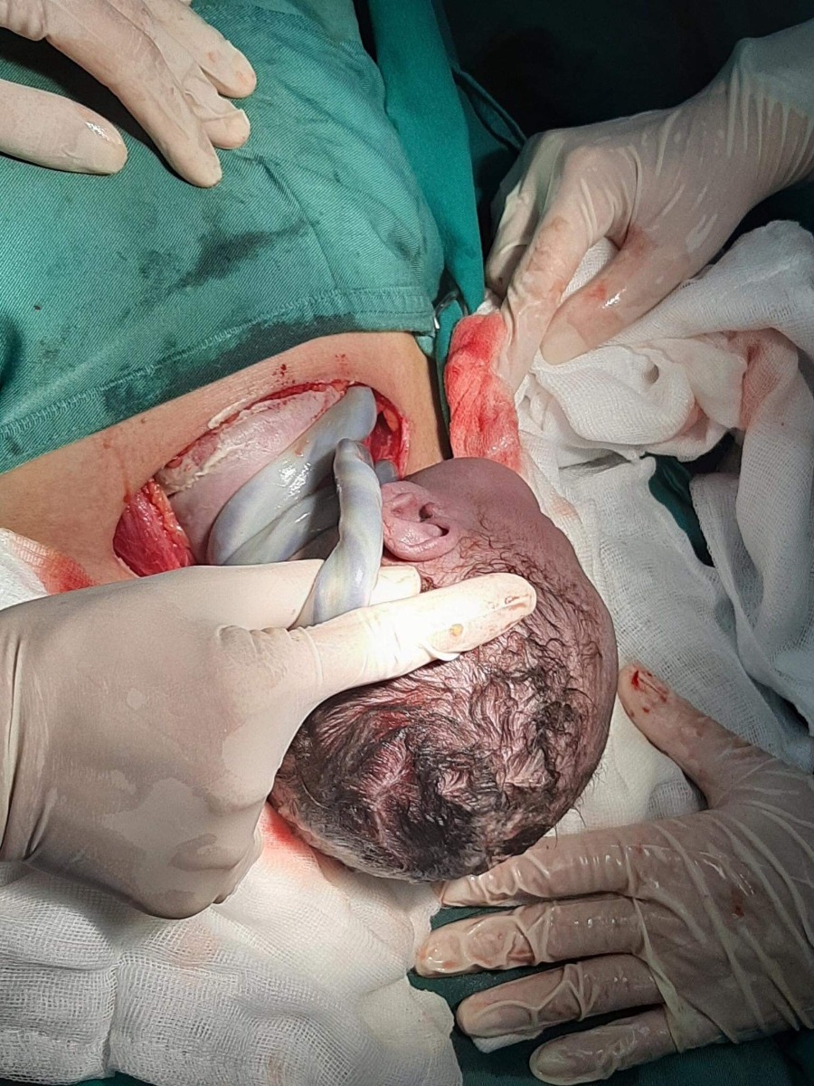 Cuốn cổ 3 vòng nhưng con cũng ra đc rồi ạ, chúc các mẹ sớm mẹ tròn con vuông giống em nha 😍 Cảm ơn Mamibabi đã giúp em thai giáo rất nhiều ạ. App dễ dùng, hay lắm chị em nhé. Có đứa sau nhất định em sẽ dùng tiếp.