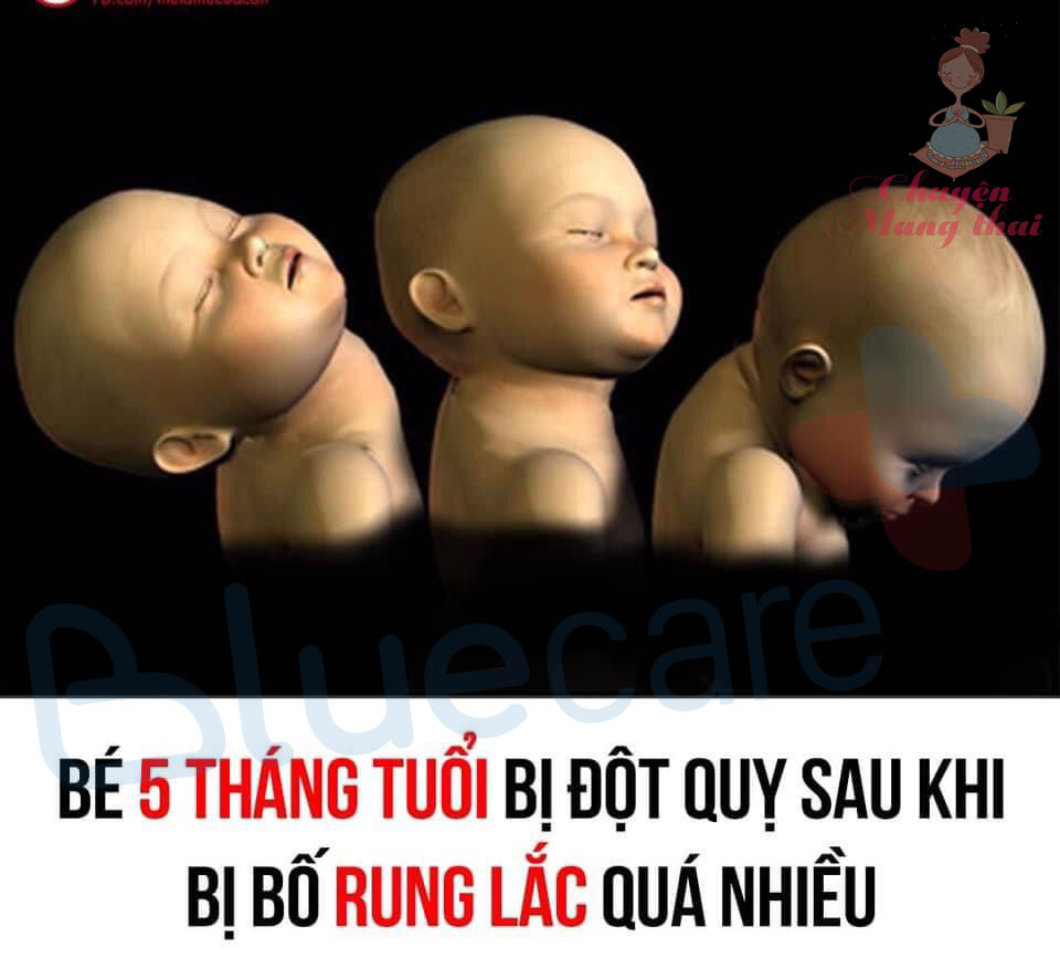 👉HỒI CHUÔNG CẢNH TỈNH CHO CHA MẸ, VUI THÔI ĐỪNG VUI QUÁ😱
BÉ 5 THÁNG BỊ ĐỘT QUỴ DO BỐ RUNG LẮC MẠNH

Trên thế giới đã có rất nhiều cảnh báo về hành động rung lắc trẻ sơ sinh. Hậu quả của hành động vô ý thức này có thể làm cho bố mẹ ân hận suốt đời, do di chứng để lại cho bé rất nặng nề. Một vụ tai nạn thương tâm lại tiếp tục xảy ra với bé gái Rymer 5 tháng tuổi đến từ Mỹ sau khi cô bé bị chính bố dượng Mason Kamrowski bế và rung lắc tại nhà trong lúc mẹ bé đi ra ngoài và nhờ trông bé.

Mason Kamrowski, 20 tuổi, đã bị kết án tội và bị kết án tù 22 năm vào thứ tư ngày 27 tháng 11 vừa qua.

Kamrowski trông coi bé Rymer khi mẹ bé đi mua sắm. Khoảng 6:30 chiều hôm đó, Kamrowski vội đưa Brynley đến Bệnh viện Altru cấp cứu. Các bác sĩ cho biết bé gái bị ba cơn đau tim và hai lần đột quỵ trên đường đến bệnh viện, trước khi mất vào ngày hôm sau.

Nguyên nhân được cho là bé gặp phải hội chứng rung lắc (Shaken Baby Syndrome) khiến não bộ tổn thương và gây ra hàng loạt các tai biến nghiêm trọng như vậy.

Mắc dù hậu quả của việc rung lắc trẻ sơ sinh, trẻ nhỏ đã được cảnh báo khá nhiều, nhưng vẫn có rất nhiều bậc cha mẹ, người trông trẻ còn thờ ơ và chưa hiểu rõ về tác hại vô cùng nghiêm trọng mà nó có thể để lại cho trẻ, ảnh hưởng tới sức khỏe, tính mạng của trẻ. Do cổ bé còn yếu và chưa thể nâng đỡ được phần đầu nên khi có lực tác động mạnh sẽ gây ra các vấn đề nghiêm trọng có thể kể đến như trẻ bị xuất huyết não, hôn mê sâu, chấn thương suốt đời như mù, liệt, thậm chí mất mạng.

Hội chứng rung lắc ở trẻ em xảy ra do thói quen vô ý và thiếu hiểu biết của người lớn khi rung lắc trẻ sơ sinh để dỗ ngủ, tung con lên cao để chọc cho bé vui cười, lay con giận dữ vì trẻ khóc ngằn ngặt cũng dễ dẫn đến hội chứng này.

P/s: Bố mẹ nên chú ý nhé