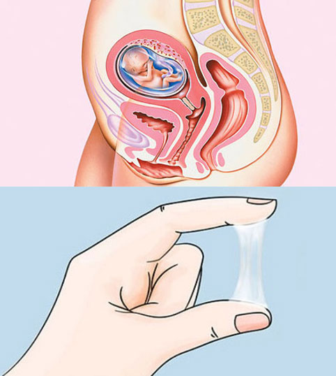 Bong nút nhầy tử cung sớm: Hiểu để xử lí sớm