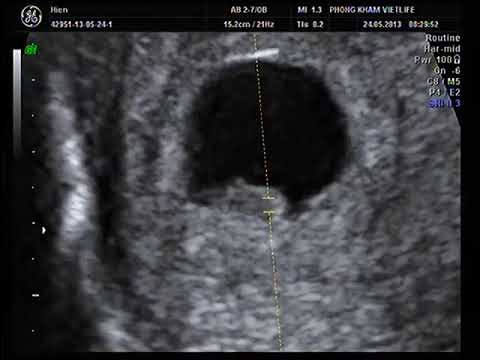 hình ảnh siêu âm thai 7 tuần