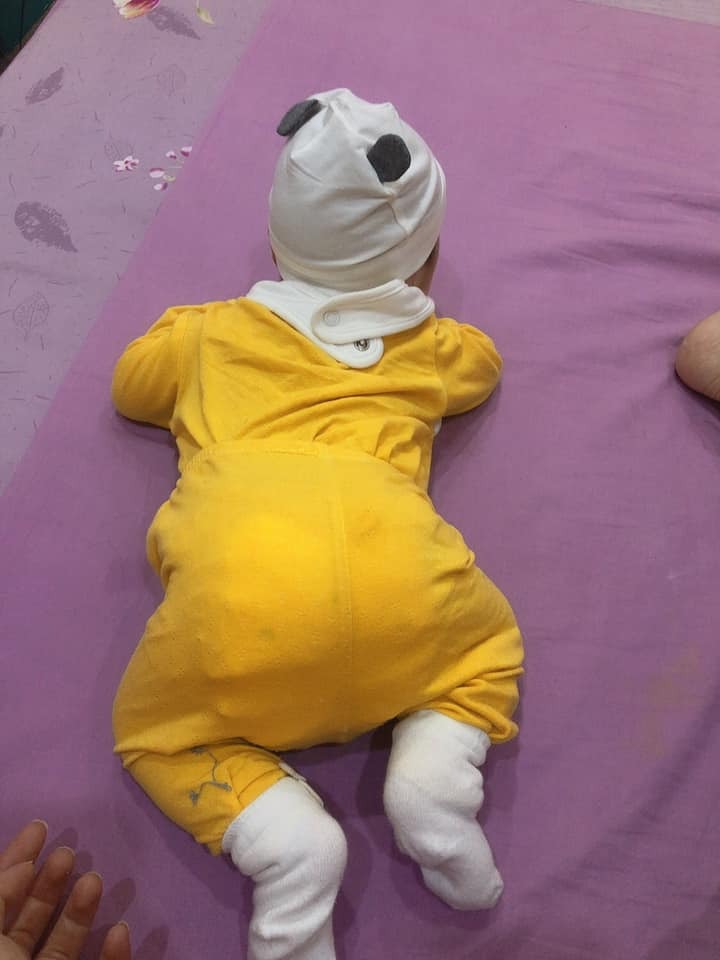 Rảnh ! Rewiew cho mọi người về mổ đẻ ở PSTW
Minh mới mổ đc 2.5tháng! Cuối t8/2020
Mình theo bác sỹ Đặng Anh Linh ngay từ ngày đầu nên chi theo bác ý khám và làm xét nghiệm 2 lần: ( theo chỉ định của bsy linh) đc cái cổng nhà bác ý là Melatec nên đến khám rồi đi bộ ra 10 bước chân làm xét nghiệm luôn ko phải đi lại nhiều!
Đến tuần 37 mình qua viện khám và làm hs: hết khoảng 2triệu
Ngày mổ: hẹn bác sỹ 3h chiều mổ thì sáng o nhà chuẩn bị, tắm giặt, gội đầu 2h đi tu nhà ra viện ( nhà mình gần viện) gọi cho bác sỹ, bác gọi cho 1 cô nhờ làm hồ sơ cho mình rồi đẩy lên phòng mổ!
Vừa mổ vừa nói chuyện 3:20p con ra! Bác bảo: thik nhỉ, theo dõi nó từ lúc nó bằng hạt gạo giờ bế nó ra như này! Bạn nhà mình đc 3.1kg mẹ tăng 10kg!
Mình làm các dịch vụ:
- chọn bác sỹ, chọn ngày giờ
- giảm đau
- nằm phòng dịch vụ 3 người /1 phòng toà BC
- kiểm tra dị tật tim bẩm sinh
- lấy máu gót chân
- ktra siêu âm ổ bụng và vết mổ sau sinh
Có bảo hiểm trái tuyến lúc ra viện thanh toán: khoảng 17triệu

Nói chung thấy khá ổn và yên tâm vì:
- con hàng ngày đc bế đi tắm, có bác sỹ khoa nhi xuống thăm khám mỗi sáng!
- Vết mổ lành ngay giờ nhìn khá đẹp rồi! ( mac du mổ lần 2)
- thik nhất là vì có giảm đau nên mổ lúc 3h chiều khoảng 4h sáng hôm sau minh ngồi dậy cho con bú
- em bé 11h đêm ngày hôm đấy đc vè vối mẹ luôn
- đc các cô y ta vào dạy massge gọi sữa về nen mình có sữa ngay sau 1 ngày

Đi đẻ cũng ko chuẩn bị nhiều đồ: bỉm của mẹ và con, sữa meji thanh, quan áo cho con và me 1 bộ, tiền và các giấy tờ !

Để đứa thứ 3 mình vẫn chọn PSTW mọi thứ thật yên tâm