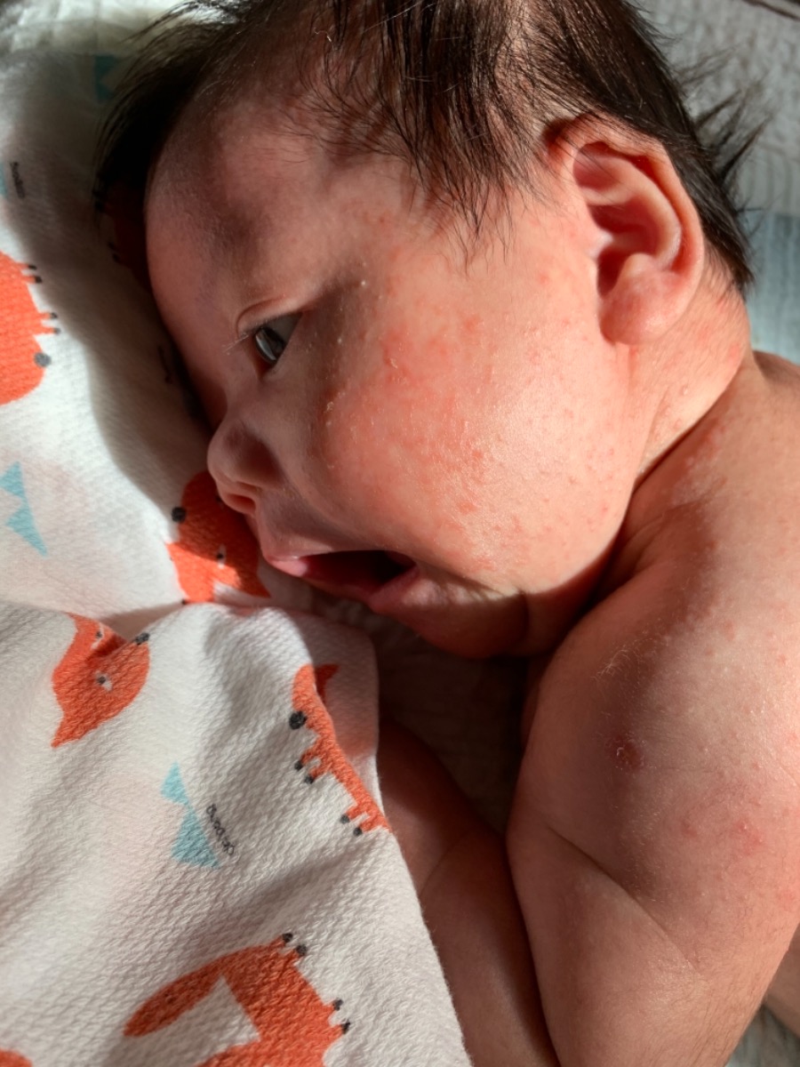 Hi các Mom! E mới sinh bé được hơn một tháng. Bé bây giờ đang bị chàm sữa. E nhìn mà xót con quá. Hiện e đang vệ sinh mặt cho bé bằng nước muối sinh lý pha với nước ấm. Mom nào có biết kem trị chàm sữa nào tốt không giới thiệu em với 🥺🥺🥺.