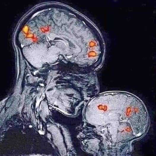 CÓ NÊN ÔM ẤP CON TRẺ HAY KHÔNG?

Đừng ngại ôm con, đừng ngại gần con, đừng sợ con bám. Những phút giây đó chỉ tồn tại vài năm đầu đời, tuổi thơ của con sẽ ko bao giờ có thể trở lại lần thứ 2.... giai đoạn đứa con bé bỏng thèm hơi mẹ mãi mãi chỉ đến 1 lần trong đời chúng...

Đây là hình ảnh cộng hưởng từ đầu tiên trên thế giới chiếu sự kết nối giữa một người mẹ và con.

Hình ảnh này của nhà thần kinh học Rebecca Sax hôn đứa con trai 2 tháng tuổi của cô ấy. Nụ hôn này đã kích hoạt một phản ứng hoá học trong bộ não con trai của cô ấy, và tạo ra rất nhiều hormone oxytocin - một loại hormone của gắn bó và tình yêu. Thật là tuyệt vời phải không?
Hình ảnh này đem đến 2 ý nghĩa lớn :

- Khi tâm trạng của người mẹ tốt, niềm hạnh phúc của cô ấy lan truyền đến con. Ngược lại, khi người mẹ u tối và cảm thấy bất hạnh, đứa bé thấm hút tất cảm xúc tiêu cực từ mẹ.

- Khi người mẹ có những cử chỉ yêu thương với con, con của cô ấy sẽ cảm thấy bình an và vui vẻ. Ngược lại, khi cô ấy lạnh nhạt với con, đứa bé sẽ chìm vào cảm xúc cô đơn, sợ hãi.

Vậy nên những người xung quanh nếu yêu đứa trẻ hãy tôn trọng và quan tâm cảm xúc người mẹ trước tiên. Đó là cách dễ dàng nhất và chân thành nhất để gửi tình yêu đến đứa trẻ!

Mỗi ng mẹ yêu con theo 1 khác nhau... chỉ duy 1 điều không bao giờ thay đổi là đứa bé luôn biết hơi ấm của mẹ là điều khiến chúng an tâm và hạnh phúc nhất ...💓