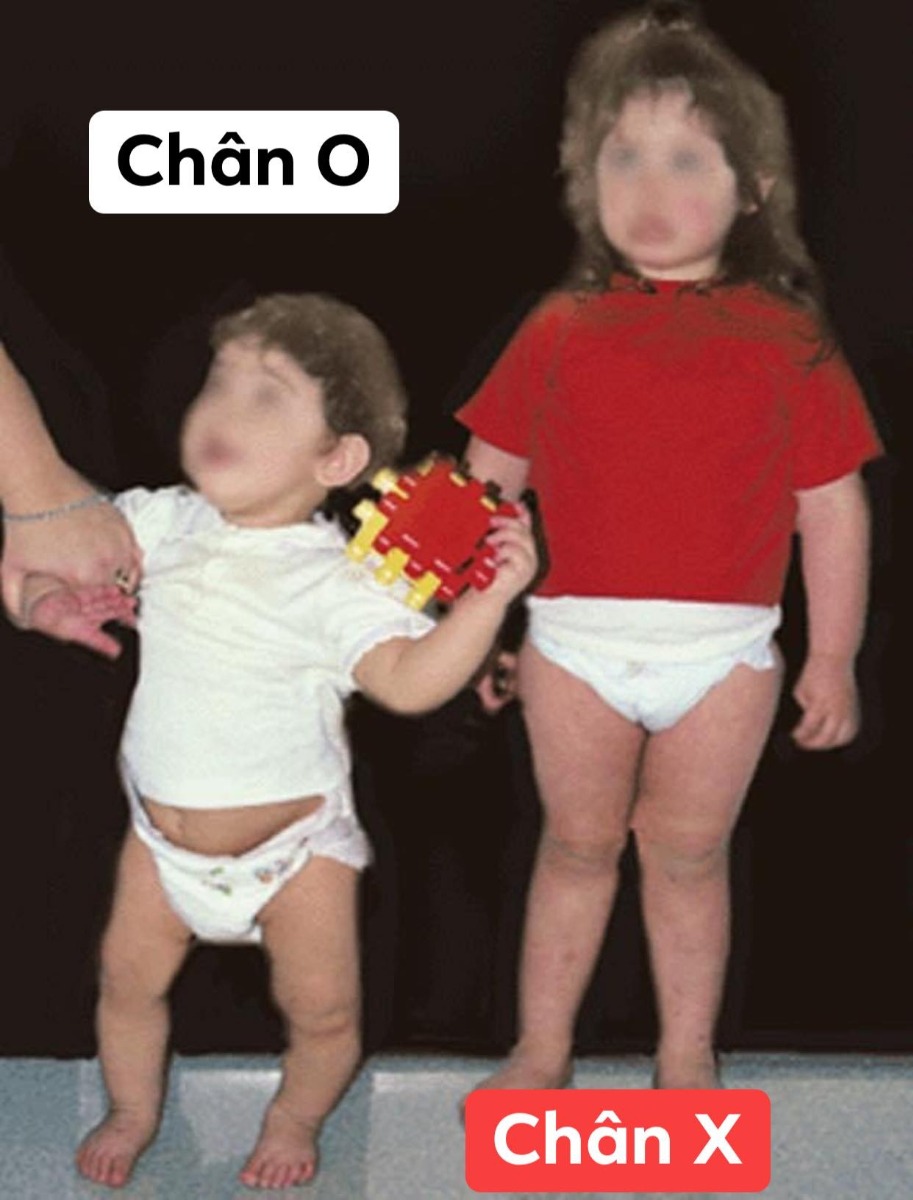 HẦU HẾT CHÂN VÒNG KIỀNG Ở TRẺ EM LÀ SINH LÝ VÀ TỰ HẾT KHI LỚN LÊN

Dạo này có một status làm hoang mang cộng đồng về việc không bế bé vì gây chân vòng kiềng cũng như không tập đi sớm vì trọng lượng cơ thể con khiến xương chân con bị cong ??!!

Đầu tiên bài này mình đọc các tài liệu chỉnh hình với 90% lấy từ bài BS Huỳnh Mạnh Nhi khá nổi tiếng với chỉnh hình Nhi và tài liệu tiếng anh. Bản thân mình không phải BS chỉnh hình nên chỉ nêu lại ý kiến chuyên môn mình góp nhặt được ở các bài giảng. Nếu có sai sót mong bỏ qua
Chuyện chân vòng kiền là hoàn toàn sinh lý vì 9 tháng hình thành trong tử cung bé nằm cuộn tròn và cấu trúc xương chân sẽ vòng kiềng.

Thực sự, nếu bế em bé khiến cho xương chân bé biến dạng thành hình vòng kiềng thì ông bà ta chắc giờ này chân vòng kiềng hết rồi vì ngày xưa toàn bế lên nương lên rẫy vừa làm vừa trông, làm gì có xe nôi như bây giờ... điều này chắc hẳn mọi người đã biết rõ từ xa xưa chứ không cần đợi đến bây giờ mới có một status làm hoang mang dư luận như vậy

Bên cạnh đó, bất kỳ bố mẹ nào có con cũng đều hiểu rõ một điều rằng nếu trẻ chưa sẵn sàng đi hay bò thì dù có bắt ép thế nào cũng chẳng bao giờ tập đi sớm được. Có nhiều bé mới 9 tháng tuổi nhưng đã đứng vững trên 10 đầu ngón chân nếu được người lớn giữ hai tay nếu vậy có nghĩa bé đó sẽ bị chân vòng kiềng ?! Sai. 

Nếu cấu trúc xương của con chưa chịu đựng được việc đi lại thì khi ba mẹ bé ép, bé sẽ khóc và bất hợp tác vì đau đớn.

NHƯ THẾ NÀO LÀ SINH LÝ?
(1) Genu VaRUM hay chân vòng kiềng hình chữ O là kiểu chân vòng kiềng sinh lý của nhóm trẻ 1-2 tuổi
(2) Genu ValGUM hay chân vòng kiềng chữ X là kiểu chân sinh lý của nhóm trẻ 3-4 tuổi
(3) Từ 6-7 tuổi thì trục chân sẽ thẳng như người lớn

Nếu con bạn
• chân vòng kiềng kiểu đối xứng
• khoảng cách giữa 2 đầu gối hay 2 mắt cá trong không quá 8cm
• hình O hay X đúng theo tuổi ở trên 
=> thì nhiều khả năng đó là sinh lý bình thường. 

Việc kết luận con bị chân vòng kiềng bệnh lý chỉ được kết luận bởi bác sĩ CTCH sau khi chụp XQuang xương chân con ghi nhận có “tổn thương mặt trong, đầu trên xương chày” như BS Huỳnh Mạnh Nhi (BS CTCH Nhi khoa nổi tiếng) từng dạy trong bài giảng của thầy.

ĐIỀU TRỊ CHÂN VÒNG KIỀNG?
• Hiện nay, hầu hết trẻ chân O hay X chỉ cần theo dõi mỗi 6 tháng để đo khoảng cách 2 gối hay 2 mẳ cá.
• Nhóm trẻ chân O hay chân X nên tránh tăng cân quá nhanh vì có thể thúc đẩy biến dạng trục xương
• Nếu theo dõi khi lớn 6-7 tuổi mà trục xương chưa về bình thường hay từ theo dõi mỗi 6 tháng ghi nhận khoảng cách ngày càng xa, đặc biệt lớn hơn 8cm, chụp Xquang ghi nhận trục xương lệch bất thường sinh lý và đặc biệt nếu có tổn thương mặt trong đầu trên Xương chày thì cần gặp ngay BS chuyên khoa để bó bột hoặc phẫu thuật 

TÓM TẠI 
(1) Chân X hay O thường là do sinh lý và hầu hết tự ổn định sau 7 tuổi
(2) Chân kiềng chẳng liên quan việc bế nhiều hay tập đi sớm. Nếu bé chẳng muốn thì dù có ép đi sớm thì bé cũng sẽ không hợp tác, khóc lóc do đau đớn
(3) Nếu bé bạn chân O hay X thì chỉ cần theo dõi bởi bác sĩ chỉnh hình và tránh béo phì
(4) Rất ít trường hợp chân O hay X cần can thiệp phẫu thuật 
(5) Một số bé ngồi sớm từ 3-4 tháng tuổi hay đứng vững dù mới 10 tháng...thì cũng đừng quá lo lắng. Mỗi bé có một tốc độ phát triển riêng, có bé sớm có bé chậm hơn, đừng so sánh với nhau rồi đâm ra hoang mang

Nếu bé nhà mình chân X hay O, hãy tìm 1 bác sĩ chỉnh hình và tái khám mỗi 6 tháng. Đừng đọc lung tung hay share lung tung rồi hoang mang hay đi điều trị nơi không đúng chuyên môn nhé

Bs. Nguyễn Thanh Sang