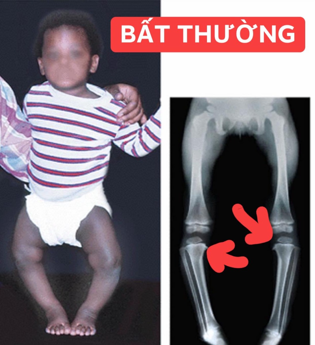 HẦU HẾT CHÂN VÒNG KIỀNG Ở TRẺ EM LÀ SINH LÝ VÀ TỰ HẾT KHI LỚN LÊN

Dạo này có một status làm hoang mang cộng đồng về việc không bế bé vì gây chân vòng kiềng cũng như không tập đi sớm vì trọng lượng cơ thể con khiến xương chân con bị cong ??!!

Đầu tiên bài này mình đọc các tài liệu chỉnh hình với 90% lấy từ bài BS Huỳnh Mạnh Nhi khá nổi tiếng với chỉnh hình Nhi và tài liệu tiếng anh. Bản thân mình không phải BS chỉnh hình nên chỉ nêu lại ý kiến chuyên môn mình góp nhặt được ở các bài giảng. Nếu có sai sót mong bỏ qua
Chuyện chân vòng kiền là hoàn toàn sinh lý vì 9 tháng hình thành trong tử cung bé nằm cuộn tròn và cấu trúc xương chân sẽ vòng kiềng.

Thực sự, nếu bế em bé khiến cho xương chân bé biến dạng thành hình vòng kiềng thì ông bà ta chắc giờ này chân vòng kiềng hết rồi vì ngày xưa toàn bế lên nương lên rẫy vừa làm vừa trông, làm gì có xe nôi như bây giờ... điều này chắc hẳn mọi người đã biết rõ từ xa xưa chứ không cần đợi đến bây giờ mới có một status làm hoang mang dư luận như vậy

Bên cạnh đó, bất kỳ bố mẹ nào có con cũng đều hiểu rõ một điều rằng nếu trẻ chưa sẵn sàng đi hay bò thì dù có bắt ép thế nào cũng chẳng bao giờ tập đi sớm được. Có nhiều bé mới 9 tháng tuổi nhưng đã đứng vững trên 10 đầu ngón chân nếu được người lớn giữ hai tay nếu vậy có nghĩa bé đó sẽ bị chân vòng kiềng ?! Sai. 

Nếu cấu trúc xương của con chưa chịu đựng được việc đi lại thì khi ba mẹ bé ép, bé sẽ khóc và bất hợp tác vì đau đớn.

NHƯ THẾ NÀO LÀ SINH LÝ?
(1) Genu VaRUM hay chân vòng kiềng hình chữ O là kiểu chân vòng kiềng sinh lý của nhóm trẻ 1-2 tuổi
(2) Genu ValGUM hay chân vòng kiềng chữ X là kiểu chân sinh lý của nhóm trẻ 3-4 tuổi
(3) Từ 6-7 tuổi thì trục chân sẽ thẳng như người lớn

Nếu con bạn
• chân vòng kiềng kiểu đối xứng
• khoảng cách giữa 2 đầu gối hay 2 mắt cá trong không quá 8cm
• hình O hay X đúng theo tuổi ở trên 
=> thì nhiều khả năng đó là sinh lý bình thường. 

Việc kết luận con bị chân vòng kiềng bệnh lý chỉ được kết luận bởi bác sĩ CTCH sau khi chụp XQuang xương chân con ghi nhận có “tổn thương mặt trong, đầu trên xương chày” như BS Huỳnh Mạnh Nhi (BS CTCH Nhi khoa nổi tiếng) từng dạy trong bài giảng của thầy.

ĐIỀU TRỊ CHÂN VÒNG KIỀNG?
• Hiện nay, hầu hết trẻ chân O hay X chỉ cần theo dõi mỗi 6 tháng để đo khoảng cách 2 gối hay 2 mẳ cá.
• Nhóm trẻ chân O hay chân X nên tránh tăng cân quá nhanh vì có thể thúc đẩy biến dạng trục xương
• Nếu theo dõi khi lớn 6-7 tuổi mà trục xương chưa về bình thường hay từ theo dõi mỗi 6 tháng ghi nhận khoảng cách ngày càng xa, đặc biệt lớn hơn 8cm, chụp Xquang ghi nhận trục xương lệch bất thường sinh lý và đặc biệt nếu có tổn thương mặt trong đầu trên Xương chày thì cần gặp ngay BS chuyên khoa để bó bột hoặc phẫu thuật 

TÓM TẠI 
(1) Chân X hay O thường là do sinh lý và hầu hết tự ổn định sau 7 tuổi
(2) Chân kiềng chẳng liên quan việc bế nhiều hay tập đi sớm. Nếu bé chẳng muốn thì dù có ép đi sớm thì bé cũng sẽ không hợp tác, khóc lóc do đau đớn
(3) Nếu bé bạn chân O hay X thì chỉ cần theo dõi bởi bác sĩ chỉnh hình và tránh béo phì
(4) Rất ít trường hợp chân O hay X cần can thiệp phẫu thuật 
(5) Một số bé ngồi sớm từ 3-4 tháng tuổi hay đứng vững dù mới 10 tháng...thì cũng đừng quá lo lắng. Mỗi bé có một tốc độ phát triển riêng, có bé sớm có bé chậm hơn, đừng so sánh với nhau rồi đâm ra hoang mang

Nếu bé nhà mình chân X hay O, hãy tìm 1 bác sĩ chỉnh hình và tái khám mỗi 6 tháng. Đừng đọc lung tung hay share lung tung rồi hoang mang hay đi điều trị nơi không đúng chuyên môn nhé

Bs. Nguyễn Thanh Sang