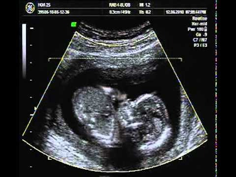 Hình ảnh thai nhi 13 tuần tuổi