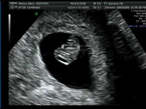 Thai 7 tuần như thế nào? Thai nhi 7 tuần chưa có tim thai?