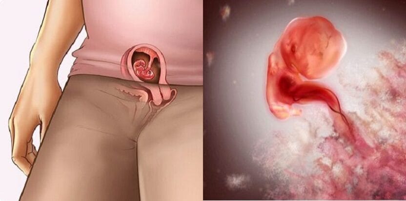 hình ảnh siêu âm thai 5 tuần