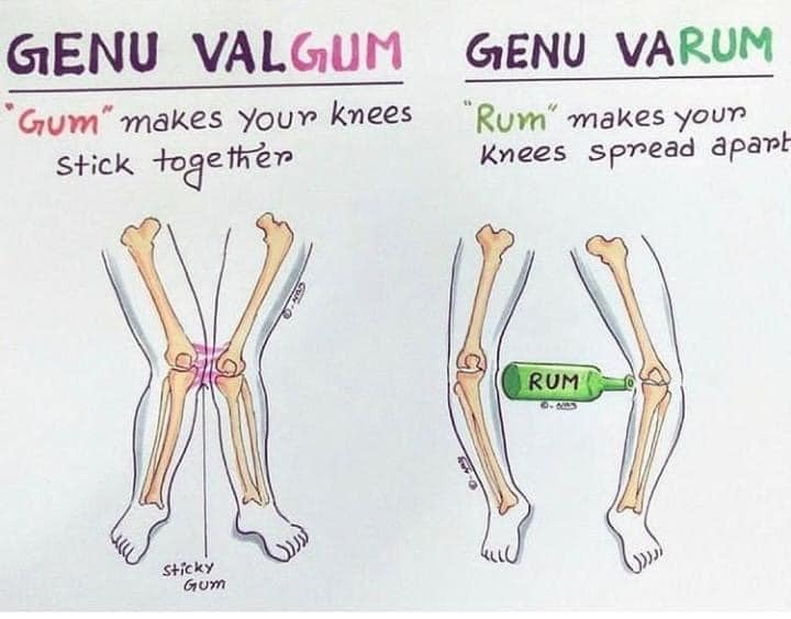 HẦU HẾT CHÂN VÒNG KIỀNG Ở TRẺ EM LÀ SINH LÝ VÀ TỰ HẾT KHI LỚN LÊN

Dạo này có một status làm hoang mang cộng đồng về việc không bế bé vì gây chân vòng kiềng cũng như không tập đi sớm vì trọng lượng cơ thể con khiến xương chân con bị cong ??!!

Đầu tiên bài này mình đọc các tài liệu chỉnh hình với 90% lấy từ bài BS Huỳnh Mạnh Nhi khá nổi tiếng với chỉnh hình Nhi và tài liệu tiếng anh. Bản thân mình không phải BS chỉnh hình nên chỉ nêu lại ý kiến chuyên môn mình góp nhặt được ở các bài giảng. Nếu có sai sót mong bỏ qua
Chuyện chân vòng kiền là hoàn toàn sinh lý vì 9 tháng hình thành trong tử cung bé nằm cuộn tròn và cấu trúc xương chân sẽ vòng kiềng.

Thực sự, nếu bế em bé khiến cho xương chân bé biến dạng thành hình vòng kiềng thì ông bà ta chắc giờ này chân vòng kiềng hết rồi vì ngày xưa toàn bế lên nương lên rẫy vừa làm vừa trông, làm gì có xe nôi như bây giờ... điều này chắc hẳn mọi người đã biết rõ từ xa xưa chứ không cần đợi đến bây giờ mới có một status làm hoang mang dư luận như vậy

Bên cạnh đó, bất kỳ bố mẹ nào có con cũng đều hiểu rõ một điều rằng nếu trẻ chưa sẵn sàng đi hay bò thì dù có bắt ép thế nào cũng chẳng bao giờ tập đi sớm được. Có nhiều bé mới 9 tháng tuổi nhưng đã đứng vững trên 10 đầu ngón chân nếu được người lớn giữ hai tay nếu vậy có nghĩa bé đó sẽ bị chân vòng kiềng ?! Sai. 

Nếu cấu trúc xương của con chưa chịu đựng được việc đi lại thì khi ba mẹ bé ép, bé sẽ khóc và bất hợp tác vì đau đớn.

NHƯ THẾ NÀO LÀ SINH LÝ?
(1) Genu VaRUM hay chân vòng kiềng hình chữ O là kiểu chân vòng kiềng sinh lý của nhóm trẻ 1-2 tuổi
(2) Genu ValGUM hay chân vòng kiềng chữ X là kiểu chân sinh lý của nhóm trẻ 3-4 tuổi
(3) Từ 6-7 tuổi thì trục chân sẽ thẳng như người lớn

Nếu con bạn
• chân vòng kiềng kiểu đối xứng
• khoảng cách giữa 2 đầu gối hay 2 mắt cá trong không quá 8cm
• hình O hay X đúng theo tuổi ở trên 
=> thì nhiều khả năng đó là sinh lý bình thường. 

Việc kết luận con bị chân vòng kiềng bệnh lý chỉ được kết luận bởi bác sĩ CTCH sau khi chụp XQuang xương chân con ghi nhận có “tổn thương mặt trong, đầu trên xương chày” như BS Huỳnh Mạnh Nhi (BS CTCH Nhi khoa nổi tiếng) từng dạy trong bài giảng của thầy.

ĐIỀU TRỊ CHÂN VÒNG KIỀNG?
• Hiện nay, hầu hết trẻ chân O hay X chỉ cần theo dõi mỗi 6 tháng để đo khoảng cách 2 gối hay 2 mẳ cá.
• Nhóm trẻ chân O hay chân X nên tránh tăng cân quá nhanh vì có thể thúc đẩy biến dạng trục xương
• Nếu theo dõi khi lớn 6-7 tuổi mà trục xương chưa về bình thường hay từ theo dõi mỗi 6 tháng ghi nhận khoảng cách ngày càng xa, đặc biệt lớn hơn 8cm, chụp Xquang ghi nhận trục xương lệch bất thường sinh lý và đặc biệt nếu có tổn thương mặt trong đầu trên Xương chày thì cần gặp ngay BS chuyên khoa để bó bột hoặc phẫu thuật 

TÓM TẠI 
(1) Chân X hay O thường là do sinh lý và hầu hết tự ổn định sau 7 tuổi
(2) Chân kiềng chẳng liên quan việc bế nhiều hay tập đi sớm. Nếu bé chẳng muốn thì dù có ép đi sớm thì bé cũng sẽ không hợp tác, khóc lóc do đau đớn
(3) Nếu bé bạn chân O hay X thì chỉ cần theo dõi bởi bác sĩ chỉnh hình và tránh béo phì
(4) Rất ít trường hợp chân O hay X cần can thiệp phẫu thuật 
(5) Một số bé ngồi sớm từ 3-4 tháng tuổi hay đứng vững dù mới 10 tháng...thì cũng đừng quá lo lắng. Mỗi bé có một tốc độ phát triển riêng, có bé sớm có bé chậm hơn, đừng so sánh với nhau rồi đâm ra hoang mang

Nếu bé nhà mình chân X hay O, hãy tìm 1 bác sĩ chỉnh hình và tái khám mỗi 6 tháng. Đừng đọc lung tung hay share lung tung rồi hoang mang hay đi điều trị nơi không đúng chuyên môn nhé

Bs. Nguyễn Thanh Sang