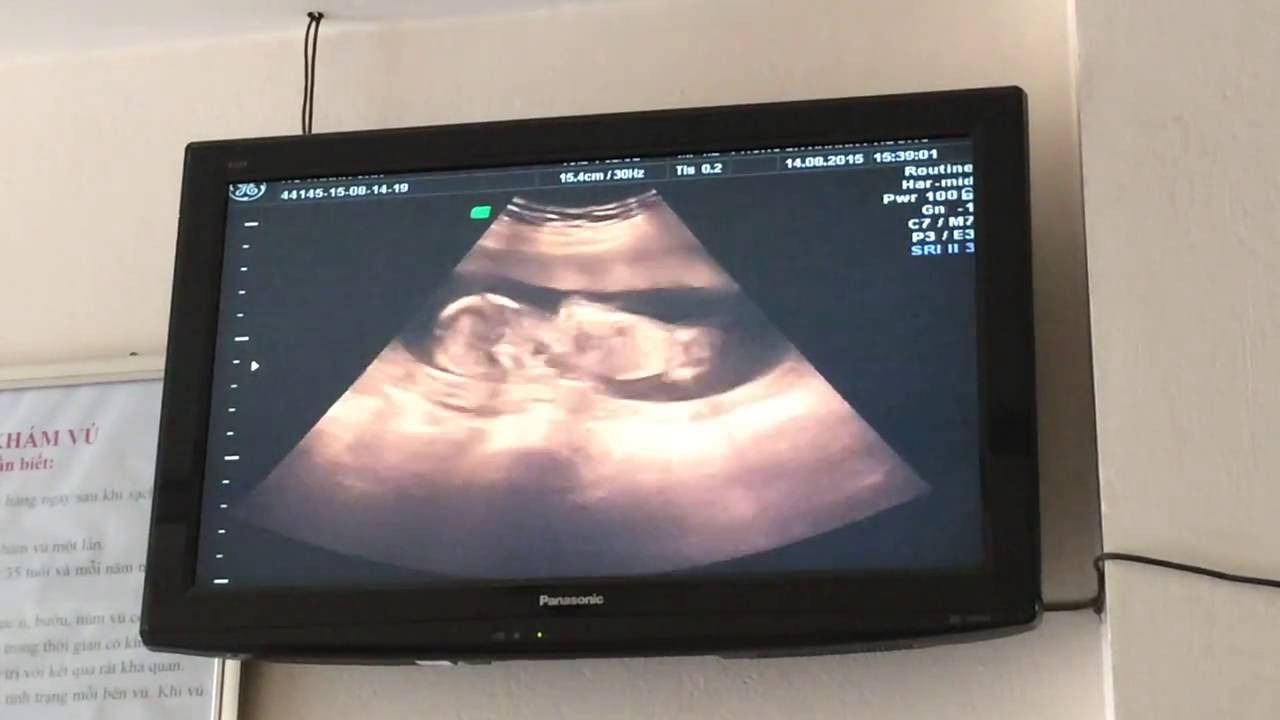 Hình ảnh siêu âm thai 15 tuần