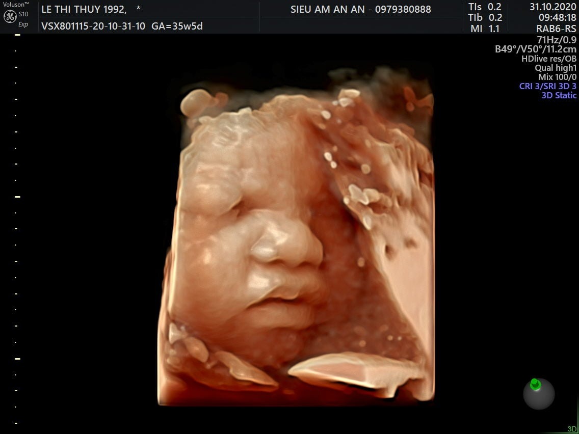 Hình ảnh siêu âm thai 36 tuần