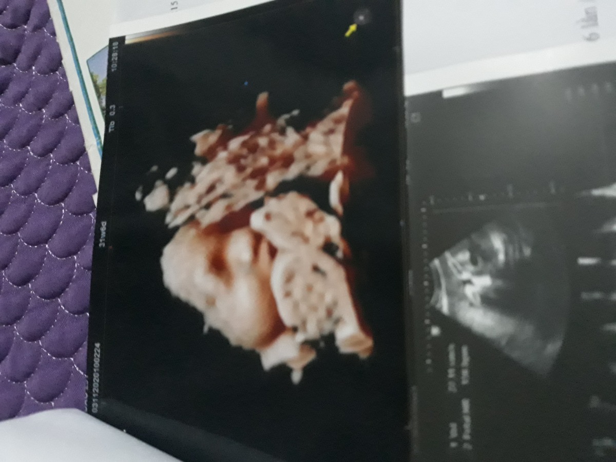 31w6d 1,8kg có nhỏ ko cac mom.me tăg 8kg a.trộm vía e khỏe và đúc cả hai tay vô mút ms đã