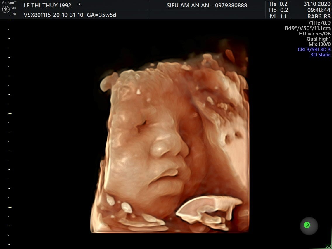Hình ảnh siêu âm thai 36 tuần
