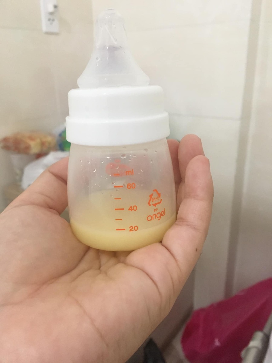 Review đi đẻ bệnh viện Hùng Vương 😀

Hút sữa xong cử 00:00 là e tỉnh ngủ, ngủ lại k được nên là buồn buồn viết bài review đi đẻ😌

13/09/2020 - Ngày mình gặp nhau đó Lavie à☺️

*** Thăm khám thai:
Từ đầu thai kỳ cho đến lúc vỡ chum e theo dõi bác sĩ tư, bác Hải Châu bv Hùng Vương . Bác hiền nhiệt tình, khám kỹ có điều lúc nào cũng đông nên là đi khám phải đi sớm nè.

*** Hành trình đi đẻ: 
Ngày 10/9/2020 e te te đi khám thai như bth, vô khám bs bảo nở 1phan về nhà theo dõi nếu tối có đau bụng thì vô bv ngay k thì mai quay lại khám tiếp, r mai quay lại khám thật tối đó khám xong bác kêu nhở 2phân r về nhập viện nha e, hỏng ai như e luôn sợ đẻ lắm hỏi bác mai sáng dc k, bác nói v thoi mai sáng cũng dc mà khuya có gì là nhập viện liền nha.

Xong về quyết định đi ăn cả thế giới, tối hôm đó vừa sợ vưa hồi hộp mà thấy sợ nhiều hơn nên là chẳng thể ngủ dc luôn.

Sáng hôm sau bs hẹn 8h nhập viện nhưng k 9h e mới dậy đi ăn sáng đồ thì đã soạn sẵn lúc tối r thế là 10h nhập viện, vô phòng nhận sanh bị la:
- ủa ủa khám thai mà đi đâu vô đây?
- dạ k chị ơi, e đi đẻ
- mấy tháng r mà đòi đẻ, ai kêu lên đây
- dạ e đi đẻ thiệt c, bác hải châu hẹn

Xong mới chịu cho e đẻ khổ ghê vậy😂😂 Thay đồ làm thủ tục xong e dc dắt lên phòng chờ sanh. đúng thật mới vô chưa đau bụng nên còn tung tăng lắm chụp hình tự sướng, đánh liên quân các kiểu, nhìn mấy chị kia đau rên mà mình ớn luôn, xong nghĩ chắc mình k đến nỗi v đâu 😅😅. Đợi tới 5h chiều vẫn chưa nở thêm đc phân nào cả. bắt vô khám trong và bị vỡ ói, ra truyền thuốc dục sinh thì ôi thoi chuyện gì tới cũng đã tới, nó đau thấy mấy chục ông mặt trời luôn chứ đừng nói là thấy 10 ông mặt trời. Chỉ biết nằm rên và thở đt thì dục 1 xó lunn, cứ mà gặp hộ lý nào đi ngang cũng kêu cho tiêm giảm đau nhưng k cho phải 3,4 phân mới đc tiêm😭😭😭. Chịu đau từ 17h đến 12h khuya thế là cuối cùng đã nở đc 3phan và đc gọi ck vô kí tên để tiêm giảm đau và cho vô phòng sanh.

Vô phòng sanh tiêm giảm đau xong thì mình lạnh và bngu kinh khủng, 1 phần đau quá nên cũng đuối. Trc đó nghe mấy mom khác review là tiêm giảm đau xong như là chết đi mà đc sống lại haizz e có thấy gì khác đâu, tiêm xong đang đau bụng lại dc bonus thêm đau lưng và đau 1 chân ủa là sao??? Nằm nhìn mấy mom khác sinh nào la nào khóc mà mình sợ thật sự luôn á, nằm đến 3h sáng bác khám trong vẫn k nở thêm dc phân nào, xong bác bảo thoi e ơi con e ngôi thai k sinh thường được r mổ nha e. Lúc này kiệt sức thật sự r gật đầu kiểu h bác muốn làm gì làm đi😂😂. 

Thế là bị đẩy đi mổ ăn cả combo đau đẻ và đau mổ oi thôiii. Vô phòng mổ lúc đầu là gây tê, bác vừa định rạch bụng mình vẫn còn cgiac, rồi k hiểu vì sao mình lại bị gây mê luôn. Ngủ 1 giấc k biết gì tầm 5,6h sáng mình dc đẩy xuống phòng hồi sức, nằm đấy đến 10h thì đc nhận con. Ẳm con lại chị ấy hỏi mình:

- Con em trai hay gái, nặng nhiêu kg e?
- Em đâu biết đâu chị
- Ủa sao kbiet e?
- E bị gây mê mà chị

Rồi chị đọc cân nặng và giới tính con, buồn thay ai cũng dc để con lên ngực, trc đó mình cứ nghĩ chắc khoảnh khắc đó nó thiêng liêng lắm, đc ôm con đc hôn con. Nhưng ko, chị ấy đặt con mình dưới chân😞😞😞. Nằm đợi đến 12h mình đc nhận phòng mẹ với con về phòng.

*** Tổng kết: 
Nhập viện 10h sáng ngày 12/9 xuất viện trua 12h ngày 16/9 nằm phòng 4 giường vì k còn phòng nào cả, cơm ngày 3 cữ đồ ăn ngon bị cái cử sáng mang lại rất sớm mới 5h sáng đã mang lại mà mình thì k có thói quen ăn sớm như vậy, phòng sạch sẽ, đc dọn vệ sinh mỗi ngày
Điểm trừ duy nhất là mẹ và bé nằm chung giường nhưng giường hơi nhỏ, khá là chật, gặp đau vết mổ nên là ngồi dậy và nhích ng thật sự rất đau. Và nếu đc e khuyên chân thành nếu có điều kiện thì nên chọn phòng 1 hoặc 2 giường thoi, vì ở chung nhiều ng, mỗi ng 1 ý gặp ng có ý thức thì k sao, như e ở cùng phòng với 2vc nọ con thì khóc miết k nín 1 giây phút nào kêu ra hỏi y tá bs xem sao thì k đi cứ để con khóc như vậy, đến khi con ngừng khóc thì đến 2vc nói chuyện đt um sùm cả phòng luôn, ở chung tập thể mà muốn chỉnh máy lạnh sao là chỉnh, thích thì tắt đèn k thích thì mở đèn ôi mình bực kinh khủng. 
Chỉ có vậy là điểm trừ thoi chứ

Bác sĩ, hộ sinh đều nhiệt tình nhẹ nhàng 💕

Tổng viện phí: 11trieu, mình tiêm thuốc kích sinh, tiêm mũi giảm đau, ở phòng 4g 800k, xông hơ vùng kín, gội đầu, tiền thuốc khi xuất viện ( mình đc hưởng bh 80% vì mổ cấp cứu trong vòng 24h)