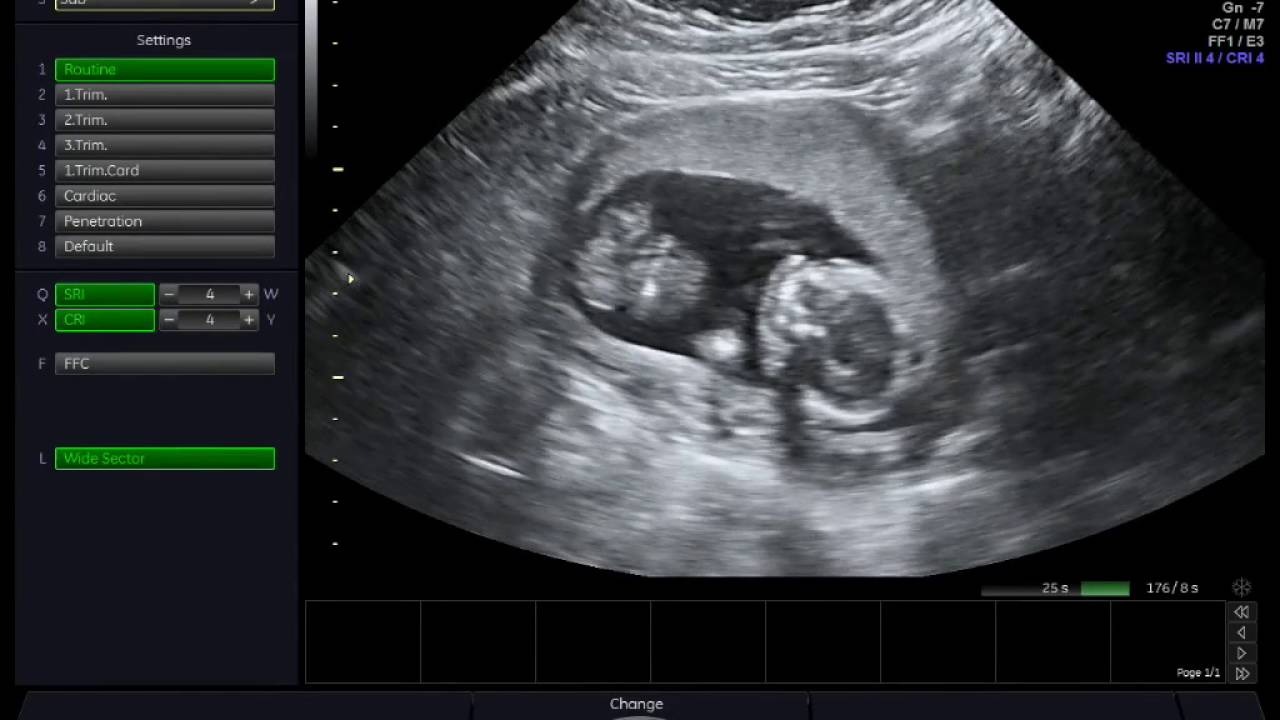 Hình ảnh siêu âm thai nhi 16 tuần tuổi