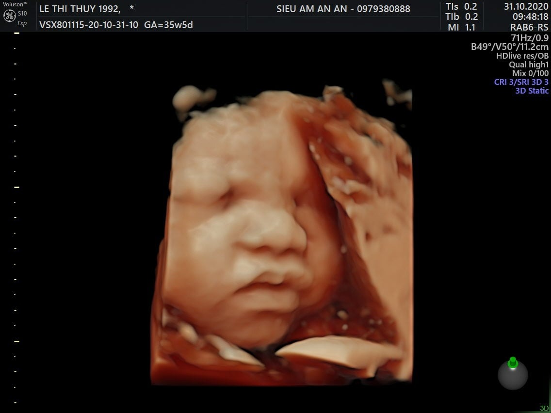 Hình ảnh siêu âm thai 36 tuần