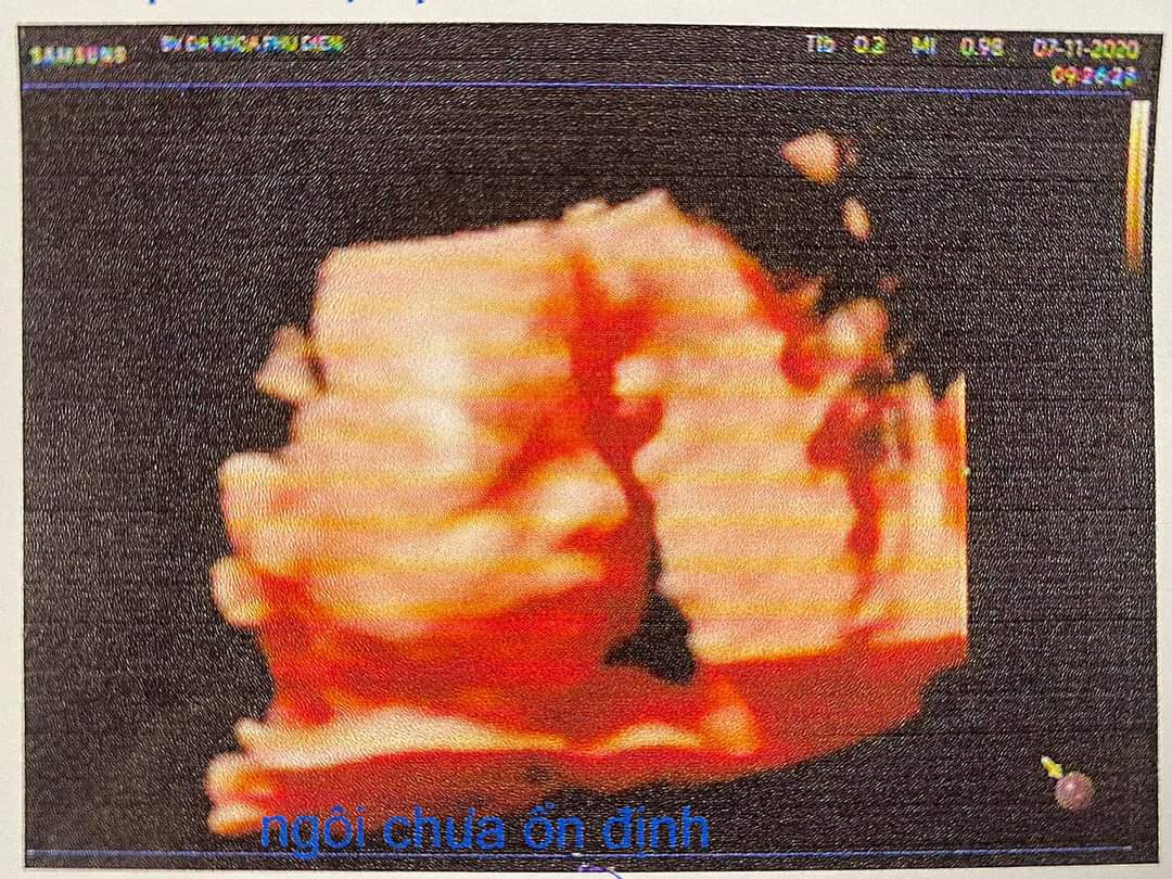 Công nhận thai giáo đều là giảm nghén. Mamibabi hay thiệt đó.
Có mom nào dự sinh tháng 3 không ạ? Em 27 tuần dsn(8/3)
Các mom lên được bao nhiêu kí rồi?? em không nghén nên ăn uống bình thường nên tăng được 10kg rồi😃😃( Thị Gạo nhà em thì được 1130g). không biết tới lúc sinh mẹ lên cân có tròn 2 chục k nữa😂 hehee