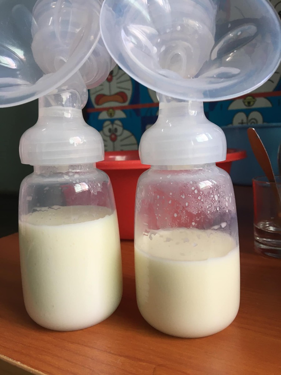 Review đi đẻ bệnh viện Hùng Vương 😀

Hút sữa xong cử 00:00 là e tỉnh ngủ, ngủ lại k được nên là buồn buồn viết bài review đi đẻ😌

13/09/2020 - Ngày mình gặp nhau đó Lavie à☺️

*** Thăm khám thai:
Từ đầu thai kỳ cho đến lúc vỡ chum e theo dõi bác sĩ tư, bác Hải Châu bv Hùng Vương . Bác hiền nhiệt tình, khám kỹ có điều lúc nào cũng đông nên là đi khám phải đi sớm nè.

*** Hành trình đi đẻ: 
Ngày 10/9/2020 e te te đi khám thai như bth, vô khám bs bảo nở 1phan về nhà theo dõi nếu tối có đau bụng thì vô bv ngay k thì mai quay lại khám tiếp, r mai quay lại khám thật tối đó khám xong bác kêu nhở 2phân r về nhập viện nha e, hỏng ai như e luôn sợ đẻ lắm hỏi bác mai sáng dc k, bác nói v thoi mai sáng cũng dc mà khuya có gì là nhập viện liền nha.

Xong về quyết định đi ăn cả thế giới, tối hôm đó vừa sợ vưa hồi hộp mà thấy sợ nhiều hơn nên là chẳng thể ngủ dc luôn.

Sáng hôm sau bs hẹn 8h nhập viện nhưng k 9h e mới dậy đi ăn sáng đồ thì đã soạn sẵn lúc tối r thế là 10h nhập viện, vô phòng nhận sanh bị la:
- ủa ủa khám thai mà đi đâu vô đây?
- dạ k chị ơi, e đi đẻ
- mấy tháng r mà đòi đẻ, ai kêu lên đây
- dạ e đi đẻ thiệt c, bác hải châu hẹn

Xong mới chịu cho e đẻ khổ ghê vậy😂😂 Thay đồ làm thủ tục xong e dc dắt lên phòng chờ sanh. đúng thật mới vô chưa đau bụng nên còn tung tăng lắm chụp hình tự sướng, đánh liên quân các kiểu, nhìn mấy chị kia đau rên mà mình ớn luôn, xong nghĩ chắc mình k đến nỗi v đâu 😅😅. Đợi tới 5h chiều vẫn chưa nở thêm đc phân nào cả. bắt vô khám trong và bị vỡ ói, ra truyền thuốc dục sinh thì ôi thoi chuyện gì tới cũng đã tới, nó đau thấy mấy chục ông mặt trời luôn chứ đừng nói là thấy 10 ông mặt trời. Chỉ biết nằm rên và thở đt thì dục 1 xó lunn, cứ mà gặp hộ lý nào đi ngang cũng kêu cho tiêm giảm đau nhưng k cho phải 3,4 phân mới đc tiêm😭😭😭. Chịu đau từ 17h đến 12h khuya thế là cuối cùng đã nở đc 3phan và đc gọi ck vô kí tên để tiêm giảm đau và cho vô phòng sanh.

Vô phòng sanh tiêm giảm đau xong thì mình lạnh và bngu kinh khủng, 1 phần đau quá nên cũng đuối. Trc đó nghe mấy mom khác review là tiêm giảm đau xong như là chết đi mà đc sống lại haizz e có thấy gì khác đâu, tiêm xong đang đau bụng lại dc bonus thêm đau lưng và đau 1 chân ủa là sao??? Nằm nhìn mấy mom khác sinh nào la nào khóc mà mình sợ thật sự luôn á, nằm đến 3h sáng bác khám trong vẫn k nở thêm dc phân nào, xong bác bảo thoi e ơi con e ngôi thai k sinh thường được r mổ nha e. Lúc này kiệt sức thật sự r gật đầu kiểu h bác muốn làm gì làm đi😂😂. 

Thế là bị đẩy đi mổ ăn cả combo đau đẻ và đau mổ oi thôiii. Vô phòng mổ lúc đầu là gây tê, bác vừa định rạch bụng mình vẫn còn cgiac, rồi k hiểu vì sao mình lại bị gây mê luôn. Ngủ 1 giấc k biết gì tầm 5,6h sáng mình dc đẩy xuống phòng hồi sức, nằm đấy đến 10h thì đc nhận con. Ẳm con lại chị ấy hỏi mình:

- Con em trai hay gái, nặng nhiêu kg e?
- Em đâu biết đâu chị
- Ủa sao kbiet e?
- E bị gây mê mà chị

Rồi chị đọc cân nặng và giới tính con, buồn thay ai cũng dc để con lên ngực, trc đó mình cứ nghĩ chắc khoảnh khắc đó nó thiêng liêng lắm, đc ôm con đc hôn con. Nhưng ko, chị ấy đặt con mình dưới chân😞😞😞. Nằm đợi đến 12h mình đc nhận phòng mẹ với con về phòng.

*** Tổng kết: 
Nhập viện 10h sáng ngày 12/9 xuất viện trua 12h ngày 16/9 nằm phòng 4 giường vì k còn phòng nào cả, cơm ngày 3 cữ đồ ăn ngon bị cái cử sáng mang lại rất sớm mới 5h sáng đã mang lại mà mình thì k có thói quen ăn sớm như vậy, phòng sạch sẽ, đc dọn vệ sinh mỗi ngày
Điểm trừ duy nhất là mẹ và bé nằm chung giường nhưng giường hơi nhỏ, khá là chật, gặp đau vết mổ nên là ngồi dậy và nhích ng thật sự rất đau. Và nếu đc e khuyên chân thành nếu có điều kiện thì nên chọn phòng 1 hoặc 2 giường thoi, vì ở chung nhiều ng, mỗi ng 1 ý gặp ng có ý thức thì k sao, như e ở cùng phòng với 2vc nọ con thì khóc miết k nín 1 giây phút nào kêu ra hỏi y tá bs xem sao thì k đi cứ để con khóc như vậy, đến khi con ngừng khóc thì đến 2vc nói chuyện đt um sùm cả phòng luôn, ở chung tập thể mà muốn chỉnh máy lạnh sao là chỉnh, thích thì tắt đèn k thích thì mở đèn ôi mình bực kinh khủng. 
Chỉ có vậy là điểm trừ thoi chứ

Bác sĩ, hộ sinh đều nhiệt tình nhẹ nhàng 💕

Tổng viện phí: 11trieu, mình tiêm thuốc kích sinh, tiêm mũi giảm đau, ở phòng 4g 800k, xông hơ vùng kín, gội đầu, tiền thuốc khi xuất viện ( mình đc hưởng bh 80% vì mổ cấp cứu trong vòng 24h)