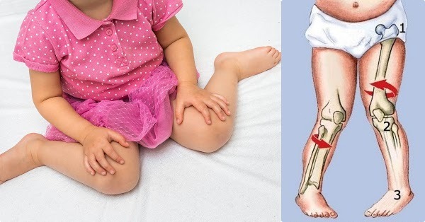 Trẻ ngồi tư thế chữ W chậm tiếp thu, dễ mang tật, hỏng cột sống

Hầu hết các bậc phụ huynh đều đã từng nghe thấy thuật ngữ “dáng ngồi W” – nhưng để hiểu tường tận về thuật ngữ này thì liệu chúng ta biết được bao nhiêu %, dáng ngồi này có tác hại như thế nào đối với con trẻ, và làm cách nào để có thể khắc phục việc này? Bài viết hôm nay của Mầm Nhỏ sẽ cung cấp cái nhìn tổng quát nhất về dáng ngồi “W” nhằm giúp các bậc phụ huynh có những thông tin hữu ích và tìm ra giải pháp phù hợp và cần thiết nhất để giúp đỡ cải thiện dáng ngồi cũng như sự phát triển của trẻ nhỏ.

DÁNG NGỒI “W” LÀ GÌ?
Ngồi “W” là hành động trẻ nhỏ ngồi ở dưới đất với bàn chân và đầu gối để phía sau. Nếu bố mẹ nhìn các bé từ trên xuống thì sẽ thấy chân các bé tạo thành hình chữ W.

Điều này thường thấy ở trẻ sơ sinh, mẫu giáo vì hành động ngồi này giúp các bé thoải mái hơn, dễ dàng đứng lên hơn các dáng ngồi khác. Nhưng điều này sẽ trở thành vấn đề khi các bé thường xuyên ngồi dáng ngồi W, và quên đi các dáng ngồi khác.

TẠI SAO KHI NGỒI DÁNG “W” THƯỜNG XUYÊN SẼ TRỞ THÀNH VẤN ĐỀ?
Theo bác sĩ Marianne McCormick – Trưởng khoa vật lý trị liệu tại bệnh viện Nhi đồng Sydney ở Randwick, việc ngồi tư thế này lâu sẽ khiến hông của trẻ đặt vào tư thế quay đầu, gây áp lực lên cẳng chân và bàn chân của trẻ. Một số trẻ áp dụng tư thế này của trẻ khiến chúng thiếu sức mạnh và khả năng kiểm soát cơ bắp của mình để tự chống đỡ khi ngồi bằng hai chân. Dáng ngồi này sẽ cho phép trọng lượng của trẻ dồn xuống đầu gối, điều này khiến các cơ bắp của trẻ hoạt động ít hơn. Khi ngồi như vậy, trẻ sẽ ít hoạt động hơn và điều này khiến trẻ gặp khó khăn khi đi bộ, đứng lên và cả chạy nữa.

Khi ngồi dáng W, trọng lượng của trẻ dồn xuống không đều, làm tăng sự chịu đựng của khớp hông và đầu gối của trẻ. Điều này có thể làm tăng nguy cơ đau đớn, ngăn chặn sự hình thành phát triển của xương đùi, hông và kéo theo việc trật khớp sau này. Chân bé có thể phát triển theo hướng cong, khuềnh.

Khi ngồi với dáng ngồi bình thường, hai chân được để thoải mái, thì việc chơi bằng cả hai tay của trẻ sẽ trở nên dễ dàng, thoải mái hơn. Trẻ quay sang 2 bên khi chơi và khi đó các cơ bắp của 2 bên tay sẽ được vận dụng một cách mạnh mẽ và kết hợp khả năng phối hợp linh động của chúng. Nhưng khi ngồi với dáng W thì để làm điều này, trẻ sẽ gặp khó khăn hơn.

CÁCH KHẮC PHỤC, HẠN CHẾ DÁNG NGỒI “W” CỦA TRẺ
Có những thời điểm trẻ nhỏ thích ngồi dáng ngồi này nhưng bố mẹ hãy yên tâm nhé, trẻ sẽ không ngồi như thế này lâu đâu. Nếu trẻ đã biết ngồi, khi thấy trẻ đang ngồi dáng ngồi này,việc bố mẹ cần làm ngay lúc này là đặt lại vị trí chân của bé,bố mẹ nhé.Nếu bé lớn hơn, thì bạn hãy nói cho bé hiểu rằng: “Mẹ/ Bố nghĩ con cần phải ngồi lại vì ngồi như này sẽ không tốt cho con!”.

Các bậc phụ huynh có thể gợi ý cho trẻ các dáng ngồi kiểu khác tốt hơn như ngồi thẳng duỗi hai chân hoặc để hai chân quay sang một bên, ngồi hai chân bắt chéo để trước mặt… và luôn nhắc nhở bé khi ngồi giữ thẳng lưng tạo điều kiện tốt cho sự phát triển của cột sống và chiều cao sau này. Thậm chí bố mẹ có thể khuyến khích con chơi trong tư thế quỳ, hoặc chuẩn bị cho con những túi hạt đậu xốp (hay còn gọi là bean bag) để ngồi khiến bé thoải mái hơn khi chơi.

Với sự gợi ý, khuyến khích con ngồi dáng ngồi mới, trẻ sẽ dần dần tự động không ngồi dáng ngồi W nữa. Bố mẹ hãy giúp con điều chỉnh dần dáng ngồi nhé, chỉ cần để ý một chút trẻ nhỏ sẽ được phát triển toàn diện, khỏe mạnh hơn,nhưng nếu lâu dài thì hậu quả sẽ khó có thể khắc phục được bố mẹ ạ! Tuy nhiên nếu bố mẹ nào còn lăn tăn về dáng ngồi này, cũng như sự phát triển của con mình thì bố mẹ hãy tham khảo ý kiến của bác sĩ nhi khoa nhé.

Đừng để khi con hơn 6 tuổi mẹ mới điều chỉnh dáng ngồi cho con thì đã muộn. Tốt hơn ngay khi trẻ biết ngồi, mẹ hãy rèn cho con tư thế ngồi phù hợp, không ảnh hưởng đến cấu trúc xương cũng như khả năng vận động của con.

Những đứa trẻ gặp vấn đề về dáng đi, đứng thường cảm thấy mặc cảm, dễ là đối tượng bị bắt nạt trong trường cũng như gặp nhiều trở ngại trong tương lai khi đi xin việc, kết hôn…Vì vậy, mẹ đừng để mình sinh ra một đứa trẻ lành lặn nhưng chỉ vì thói quen ngồi chữ W khiến trẻ gặp khuyết điểm về hình thể sau đó. Đây cũng chính là một trong những vấn đề mẹ cần lưu tâm trong chăm sóc nuôi dạy con.
