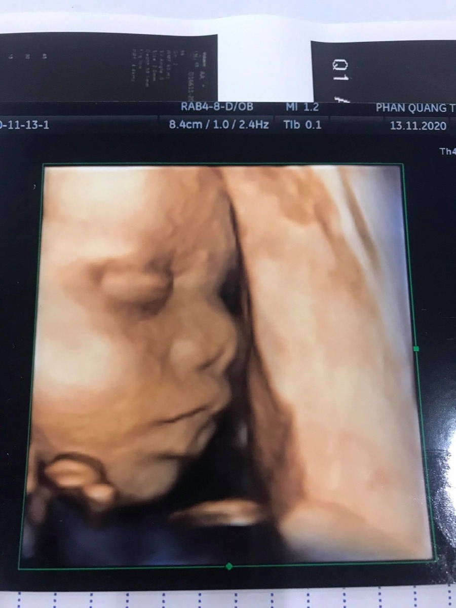 Đệ em : Quang con .
Dự sanh là 25-30/1 . Cô bác nào mát miệng chúc cho mau ra với em với ạ 😁😁
Con cảm ơn Mamibabi giúp mẹ con thai giáo tốt lắm ạ , tvia mẹ  ít nghén , cả kì thai khỏe mạnh 😁😆