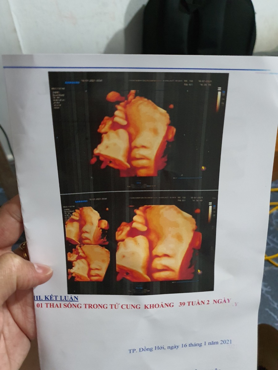 Em dự sinh 21.1, con nay đc 3.5kg, con quay đầu lúc 28w, hay gò cứng bụng cả tuần nay mà vẫn chưa chịu ra với Mẹ. Chuột gái nhưng nghịch lắm ạ, thích hóng hớt nói chuyện. 
Em cần lắm một cơn chuyển dạ. 😅😅😅
Chỉ mong đc sinh thường, sinh nhanh thôi ạ 😅