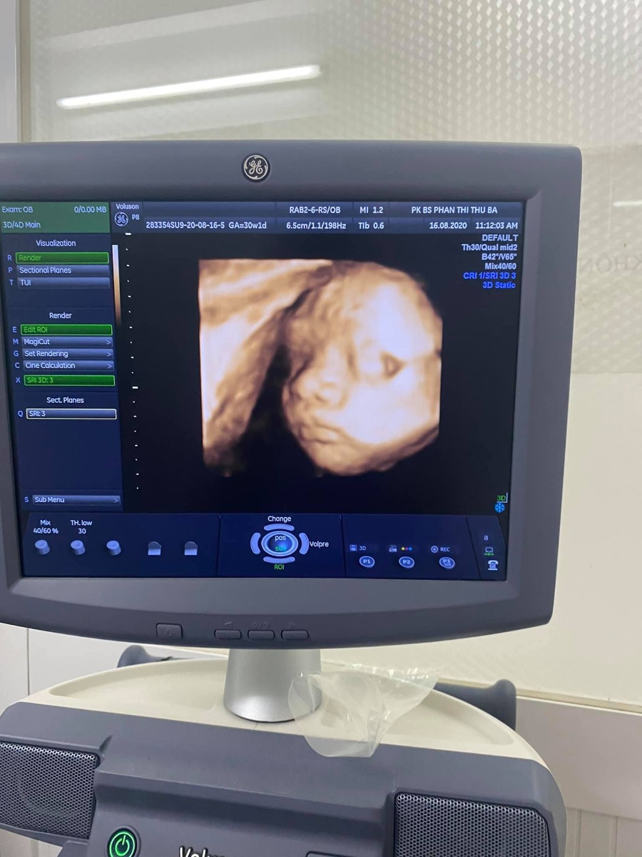 Siêu chụp 4D sanh ra y chang k sai 1 nét nhé mấy mom hihi. Chuột trai nhà e tròn 1 tháng tuổi r ạ. Chúc mấy mom 1 thai kỳ khoẻ mạnh nhé. Khoe ảnh 4d và hiện tại của chuột con đi mấy mom.