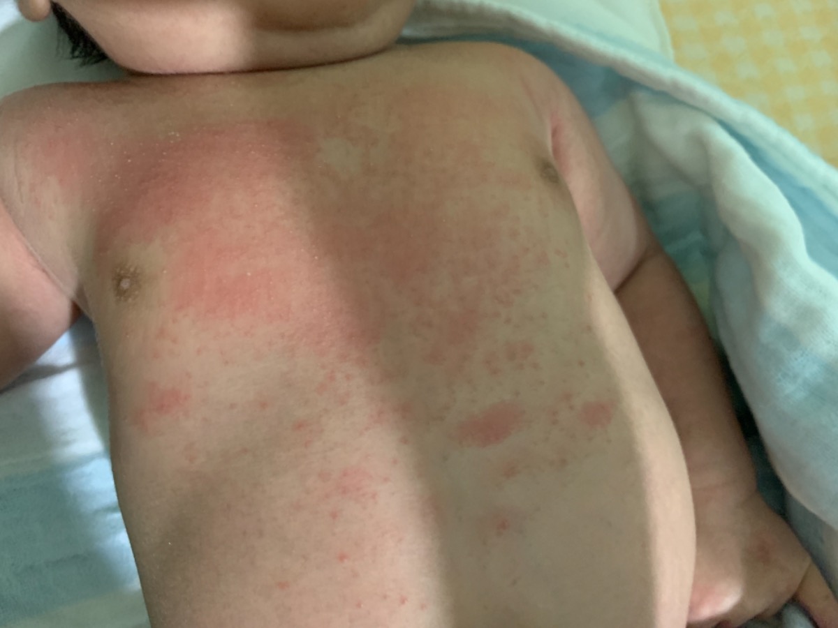 Con mình 30 ngày tuổi, 2 ngày nay bé bị nổi đỏ kèm hột trắng. Bé vẫn bú ngon ngủ ngon. E tắm lá cho bé mà vẫn ko đỡ. 
 Các mẹ có con bị như này chưa? Cho e biết e phải bôi gì và làm gì với ạ?