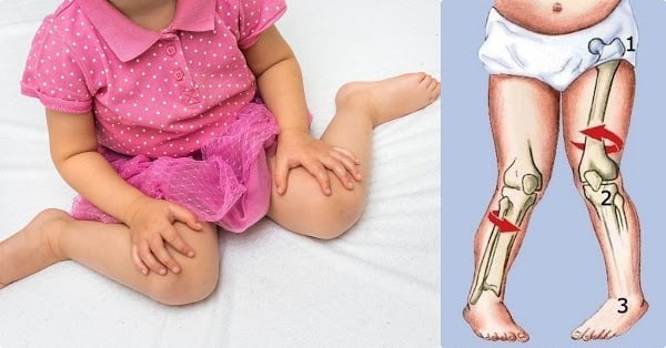 Trẻ ngồi tư thế chữ W chậm tiếp thu, dễ mang тật, hỏng cột sống

DÁNG NGỒI “W” LÀ GÌ?
Ngồi “W” là hành động trẻ nhỏ ngồi ở dưới đất với bàn chân và đầu gối để phía sau. Nếu bố mẹ nhìn các bé từ trên xuống thì sẽ thấy chân các bé tạo thành hình chữ W.
Điều này thường thấy ở trẻ sơ sinh, mẫu giáo vì hành động ngồi này giúp các bé thoải mái hơn, dễ dàng đứng lên hơn các dáng ngồi khác. Nhưng điều này sẽ trở thành vấn đề khi các bé thường xuyên ngồi dáng ngồi W, và quên đi các dáng ngồi khác.

TẠI SAO KHI NGỒI DÁNG “W” THƯỜNG XUYÊN SẼ TRỞ THÀNH VẤN ĐỀ?
Theo bác sĩ Marianne McCormick – Trưởng khoa vật lý trị liệu tại bệnh viện Nhi đồng Sydney ở Randwick, việc ngồi tư thế này lâu sẽ khiến hông của trẻ đặt vào tư thế quay đầu, gây áp lực lên cẳng chân và bàn chân của trẻ. Một số trẻ áp dụng tư thế này của trẻ khiến chúng thiếu sức mạnh và khả năng kiểm soát cơ bắp của mình để tự chống đỡ khi ngồi bằng hai chân. Dáng ngồi này sẽ cho phép trọng lượng của trẻ dồn xuống đầu gối, điều này khiến các cơ bắp của trẻ hoạt động ít hơn. Khi ngồi như vậy, trẻ sẽ ít hoạt động hơn và điều này khiến trẻ gặp khó khăn khi đi bộ, đứng lên và cả chạy nữa.
Khi ngồi dáng W, trọng lượng của trẻ dồn xuống không đều, làm tăng sự chịu đựng của khớp hông và đầu gối của trẻ. Điều này có thể làm tăng nguy cơ đau đớn, ngăn chặn sự hình thành phát triển của xương đùi, hông và kéo theo việc trật khớp sau này. Chân bé có thể phát triển theo hướng cong, khuềnh.
Khi ngồi với dáng ngồi bình thường, hai chân được để thoải mái, thì việc chơi bằng cả hai tay của trẻ sẽ trở nên dễ dàng, thoải mái hơn. Trẻ quay sang 2 bên khi chơi và khi đó các cơ bắp của 2 bên tay sẽ được vận dụng một cách mạnh mẽ và kết hợp khả năng phối hợp linh động của chúng. Nhưng khi ngồi với dáng W thì để làm điều này, trẻ sẽ gặp khó khăn hơn.
CÁCH KHẮC PHỤC, HẠN CHẾ DÁNG NGỒI “W” CỦA TRẺ
Có những thời điểm trẻ nhỏ thích ngồi dáng ngồi này nhưng bố mẹ hãy yên tâm, trẻ sẽ không ngồi như thế này lâu đâu. Nếu trẻ đã biết ngồi, khi thấy trẻ đang ngồi dáng ngồi này,việc bố mẹ cần làm ngay lúc này là đặt lại vị trí chân của bé,bố mẹ nhé.Nếu bé lớn hơn, thì bạn hãy nói cho bé hiểu rằng: “Mẹ/ Bố nghĩ con cần phải ngồi lại vì ngồi như này sẽ không tốt cho con!”.

Các bậc phụ huynh có thể gợi ý cho trẻ các dáng ngồi kiểu khác tốt hơn như ngồi thẳng duỗi hai chân hoặc để hai chân quay sang một bên, ngồi hai chân bắt chéo để trước mặt… và luôn nhắc nhở bé khi ngồi giữ thẳng lưng tạo điều kiện tốt cho sự phát triển của cột sống và chiều cao sau này. Thậm chí bố mẹ có thể khuyến khích con chơi trong tư thế quỳ, hoặc chuẩn bị cho con những túi hạt đậu xốp (hay còn gọi là bean bag) để ngồi khiến bé thoải mái hơn khi chơi.

Dược Sĩ Hải Tùng