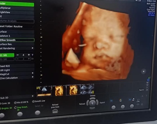 Hôm nay cháu đi gặp các bâc... Mà vui wua đê. Sau 34 tuần mang noa trong bụng . Đi khắp nơi mà chả có duyên xem mặt nó. Nay duyên lắm. 

Nhờ làm theo các bài thai giáo trên app là cháu như ông gióng ý . hợp tác với mẹ lắm, biét nge giọng mẹ r, lần nào mẹ gọi là cugx ngọ ngoạy, cưng xĩu

cảm ơn mamibabi ạ