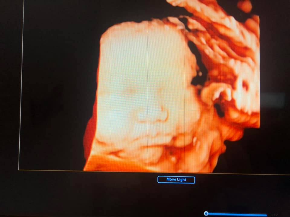 Ôi về nhà mà nhớ viện thực sự các m ạ 😂😂
Kể về hành trình đi đẻ của m nhé:
Đây là bạn thứ 2 nhà mình, b đầu mk đẻ thường khá là dễ dàng nên b này mk cũng đăng kí theo dõi đẻ thường từ tuần 32. B này đc cái rất thích dọa mẹ nên tuần 36 và 38 nửa đêm mk pải bắt xe từ quê lên viện để đẻ( cứ tưởng đc đẻ ) 😂😂. Mà lúc đêm vào viện thì có dấu hiệu chuyển dạ mà sáng lại bt 🥲. Đến hôm 39w6d mk cũng bị đau bụng từ đêm nhưng rút kinh nghiệm sáng hôm sau ăn sáng no nê ms đủng đỉnh đi vào viện. Vào viện khám trong vẫn chưa mở mặc dù bụng rất đau, ơ kìa cái bạn Bông này kì ghê 🥲🥲. Và mẹ cháu quyết định xin mổ vì mẹ cháu bị trĩ nặng, lúc ấy hậu môn sưng tấy đỏ rát có cảm giác sắp vỡ ra đến nơi rồi 😅😅. Bác sĩ hỏi “ cháu suy nghĩ kĩ chưa “ mình Tl luôn “ cháu suy nghĩ kĩ lắm rồi ạ”, bác hỏi “ thế cháu có muốn chọn bác nào mổ không” “ dạ bác nào cũng được ạ, cháu chỉ muốn con ra bây giờ thôi “ 😹😹. Thế là bác gọi cho bác Phê báo 11h có sản phụ mổ chủ động. Từ 9h đến 11h có 1 bác gọi mình ra giải thích lợi và hại của việc sinh mổ, và đợi ng nhà đến kí nốt vào giấy tờ. 10h45 mk đc đưa đi lên phòng mổ, lúc đi có cô Thắm động viên an ủi bảo k đau đâu nhé k pải sợ, mình rất hùng dũng bước vào phòng mổ, bắt đầu kim tiêm đâm vào người. Lúc gây tê như kiến cắn thôi và mình hơi khó lấy ven 😂😂, nhưng cứ thả lỏng là thấy OK hết nên các mẹ đừng sợ nhé 😅. Tiêm tê xong mk có cảm giác Mông lung như 1 trò đùa, muốn nhấc chân nhưng k thể nhấc nổi, thế là bị vần đúng như con nhợn nái vậy 😂😂😂. Mk nhìn lúc tiêm xong là 11h10, sau đó bị phủ vải xanh lên và k biết các bác làm j ở dưới, bỗng nhiên thấy hơi khó thở và “ oe oe oe “, e bé Bông đã ra đời 🥰🥰🥰 vào lúc 11h14p 🤩. Sau đó e bé đc đưa về phòng da kề da với bố, mẹ ở lại khâu và theo dõi hậu phẫu. Ôi lúc ấy thời gian trôi thật là chậm, mk còn k ngủ đc cứ chỉ mong nhanh nhanh để về với con😂. Cũng may có 1 c y tá ngồi cùng theo dõi mk 🤩. Tác dụng phụ của thuốc gây tê với mk là tự nhiên run cầm cập 30p nhưng vẫn trong giới hạn chịu đc. Sau khi hết run mk đc về với con gái 😘, nhìn mặt nàng ý quạu thật sự😹😹
Thời gian lưu viện của mình là 4 ngày và nhà mk thích riêng tư nên đki nâng cấp lên phòng VIP, ở phòng 505, các bác và các cô rất nhiệt tình hỏi thăm. Mk cần j thì bấm chuông gọi các cô kể cả đêm ( cũng ngại nhưng đau quá ) 😂. Đồ ăn của viện rất vừa miệng mình và ngày nào mk cũng ăn hết suất 😂😂. 2 hôm nay về nhà bà chỉ cho ăn thịt nạc vs rau ngót chán quớ nhớ cơm viện ghê ấy 😂😂
Về kinh phí thì mình đki gói đẻ thường 32w là 17tr520, sau đó phát sinh mổ thêm 13tr, làm giảm đau 3,3tr, nâng cấp phòng 4 ngày 5,6tr, chiếu tia 5l hết 2tr050, sàng lọc cho con hết 800k nữa tổng vào tầm 40tr, được trừ 2,2tr tiền bảo hiểm y tế :)). Lúc thanh toán cũng hơi hoang mang tí nhưng ksao, đi đẻ như đi chơi thì số tiền mk bỏ ra cũng đáng, mọi thứ đã có ôba già lo 😆😆
Hẹn tầm 5 năm nữa mẹ cháu có muốn đẻ tiếp thì chúng ta lại gặp lại nhau Bảo Sơn nhé 😆😆
P/s: ảnh siêu âm lúc 39w3d và lúc đẻ ra :))