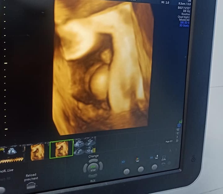 Hôm nay cháu đi gặp các bâc... Mà vui wua đê. Sau 34 tuần mang noa trong bụng . Đi khắp nơi mà chả có duyên xem mặt nó. Nay duyên lắm. 

Nhờ làm theo các bài thai giáo trên app là cháu như ông gióng ý . hợp tác với mẹ lắm, biét nge giọng mẹ r, lần nào mẹ gọi là cugx ngọ ngoạy, cưng xĩu

cảm ơn mamibabi ạ