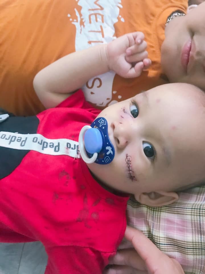 Đây là hình ảnh đứa con trai bé nhỏ mới 16m của mình.
Bé bị chó nhà cắn. Mình đăng lên đây ko phải để các Mom vào chỉ mình cách chăm con ntn
. Mình đăng là để các mom khác rút kinh nghiệm và ko cho trẻ nhỏ tiếp xúc với thú cưng trong nhà. Cho dù ngày thường bik nó có hiền và dễ thương đến mức nào . Nhưng

Khi trẻ nhỏ tiếp xúc thì ko bik hậu quả sẽ ra sau.
Và đây là sự việc đau lòng đã xảy ra với chính con trai mình khi lơ là để con chơi với cho" thú cưng" trong nhà.
Ko phải mình bận làm gì mà ko ngó tới con. Mà là mình ko ngờ cái gọi là thú cưng kia nó sẽ hại con mình ra như vậy .
Nói thêm . Chó nhà mình nuôi từ lúc còn bú sữa nay đã dc 5 năm hơn rồi . Thật tình mình vừa giận vừa thương .
Còn về phần con mình thì đau cả tim gan. Nhìn con mà chỉ bik khóc thôi . Ko bik lớn lên con có để lại thẹo ko . Rồi có bị ám ảnh tâm lý ko. Vì bé rất hoảng loạn.
Đi tim ngừa dại tận 5 mũi. Uống kháng sinh. Giờ thì phản ứng thuốc bị tiêu chẩy cả ngày.
Mong các mẹ trẻ đừng nên để trẻ tiếp xúc với thú cưng dù mình có cưng đến mấy nhưng con mình đứt ruột snah ra vẫn hơn.