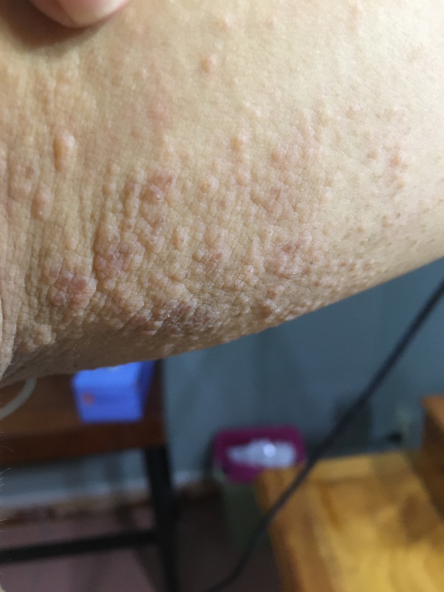 Các mẹ ơi e bầu 38 tuần mà e bị ngứa gãy riết mà 2 cánh tay e bị nổi như này jo sức thuốc j cho nó hết ạ huhu