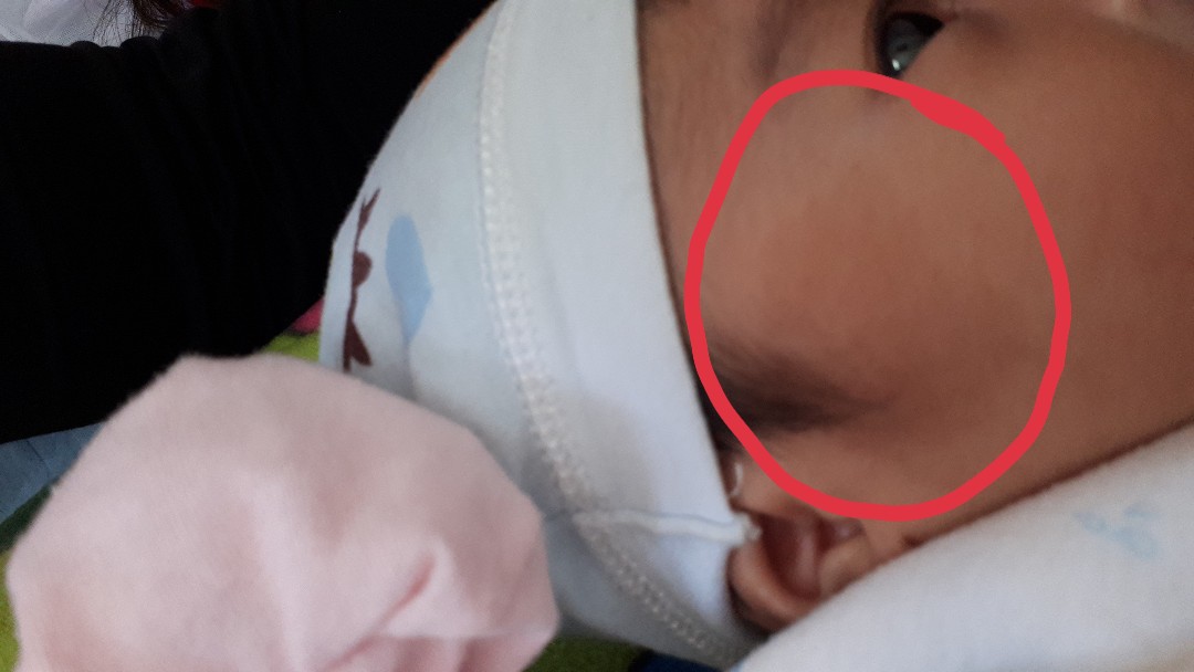 Các mom thông thái cho e hỏi bé nhà e bị gì đây ạ .có cách gì để chữa k ạ .lúc ms sinh bé chưa bị ạ