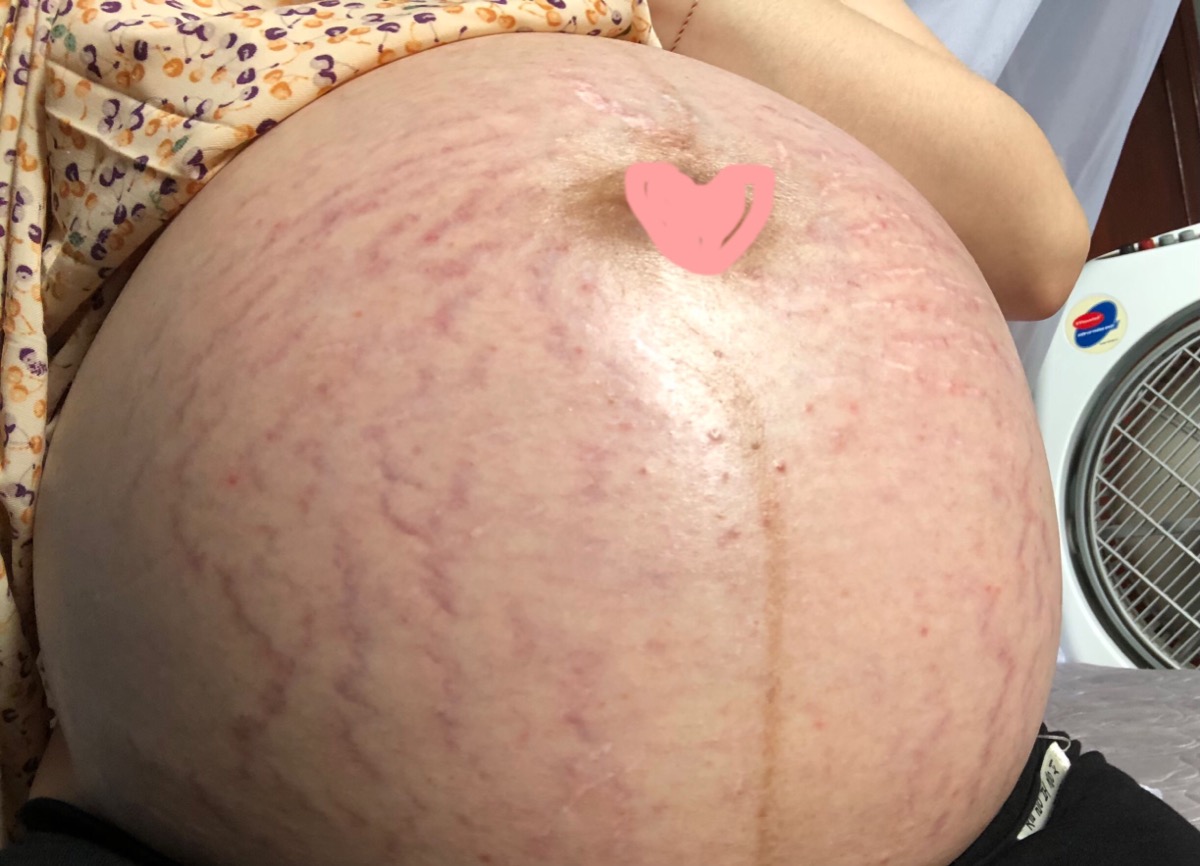 các mom cho em hỏi rạn nhiều thế này sinh xong bụng có bị nhăn nheo ko và có cách nào cải thiện ko ạ? em bầu 37w bụng và chân rạn nhanh chóng mặt, mặc dù em đã bôi dầu chống rạn rồi, mới tập đầu nên em hoang mang quá....