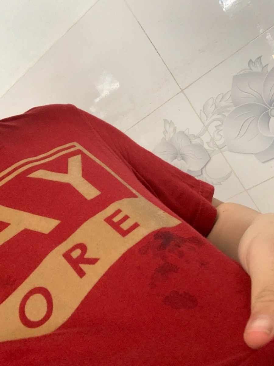 Mình đang tuần thứ 29, một bên ngực tiết sữa non như hình có bình thường k ạ. Chỉ một bên ngực là tự tiết như hình thôi ạ, bên còn laii m thử nặn nhẹ cũng có nhưng k ướt áo. Mình ggl thấy chảy sữa non một bên là bất thường nên lo quá 😖😖