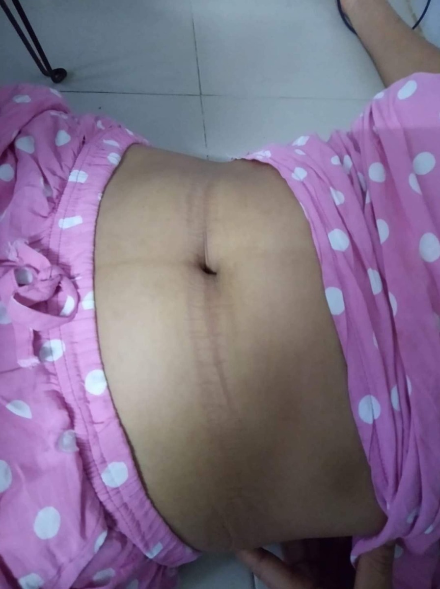 Lại là mình đây, mình chia sẽ kỹ cho các mẹ cần nhé. Bản thân mình bầu bì lên ký  nhiều. Thâm rạn sau sinh rất nhiều nên sợ nhất lấy laii da dáng vs làn da ,mình chia sẻ lại kỳ cữ của  mình con so 3 tháng 10 ngày.

Có nhiều lúc ở cữ mẹ ck vs mẹ đẻ cả 1 vd luôn đó. Mẹ đẻ mình cực kỳ xưa, có tuổi nên mẹ thường hay áp dụng cữ cho con theo kiểu xưa. Mẹ nào gần sinh hãy nói rõ làm tư tưởng cho mẹ chồng hoặc mẹ đẻ nhé. 

Mình sinh bé nên về nhà mẹ đẻ cữ nên cực kỳ thoải mái với lại mẹ mình qua những lần mình chia sẻ cũng tham khảo trên sách báo.Nên việc ở cữ của mình chu đáo kéo dài 3 tháng 10 ngày. 

Mình cữ xong là mình xuống nhà lại. 

Mình cũng đã làm tâm lý vs mẹ mình.Phòng kín nằm than sẽ ko tốt cho hai mẹ con đâu ạ  Vs lại này có nhiều cách thay thế nằm than. Xông hơ cho mẹ sau sinh

Dằn bụng bằng muối hột vs ngải cứu á mẹ. Lại an toàn mà tốt nữa.
Bôi rượu hạ thổ gừng nghệ gấc đúng 100 ngày sau sinh mình hết 4 lit. Nhưng chỉ hết thâm còn rạn vẫn còn chỉ mờ thôi.

Muối hốt vs ngải cứu  hương nhu đinh lăng củ sả sao cho thật khô rồi bỏ vào đai vải đặt lên bụng. Ngày làm một lần thôi. Kiên trì một tháng xuống bụng săn rất nhanh luôn ạ. Đỡ đau dạ con nữa đó các mẹ. 

Xông cửa mình hơi khó xúi là các mẹ tập nhấp nhả cửa mình để cho săn gọn lại. Các mẹ sd lá trầu không hoặc lá chè xanh nấu nước có thêm xúi muối hột cho sạch nhé. Rồi hơ qua than lại ạ. Sạch cực kỳ ko có mùi hôi, nấm  sau này đâu ạ.

Toàn thân các mẹ sd lá xông tươi mua ở chợ có bán . Hoặc tới tiệm thuốc đông y , thuốc bắc, thuốc nam. Bốc lá tắm cho mẹ sau sinh nhé. Về các mẹ nấu nước lên xông toàn thân vs mặt luôn ạ.xông dc thoải mái nhẹ cả người luôn á. 

Sau khi xông mẹ nhớ bôi rượu hạ thổ . Chỗ nào rạn thân nách, cổ bụng bẹn háng cổ tay cổ chân.bôi kỹ nhé. Hết cữ đỡ thâm rạn .Da bao đẹp luôn ạ.

 Về sữa mẹ các mẹ ăn uống đầy đủ chất tránh chua cay, đồ sống tanh nhé. Mình ăn chí uống sôi ăn cả thế giới. Trộm vía đủ sữa cho bé bú. 
Anh chồng lên đưa xuống thấy vợ thây đổi khen gấy 1 con có khác hỷ. Kaka

Chúc  các mẹ trâu 1 kỳ cũ khỏe mạnh!