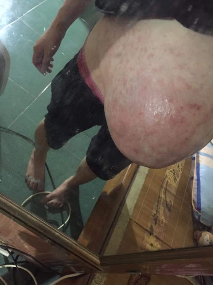 Lại là mình đây, mình chia sẽ kỹ cho các mẹ cần nhé. Bản thân mình bầu bì lên ký  nhiều. Thâm rạn sau sinh rất nhiều nên sợ nhất lấy laii da dáng vs làn da ,mình chia sẻ lại kỳ cữ của  mình con so 3 tháng 10 ngày.

Có nhiều lúc ở cữ mẹ ck vs mẹ đẻ cả 1 vd luôn đó. Mẹ đẻ mình cực kỳ xưa, có tuổi nên mẹ thường hay áp dụng cữ cho con theo kiểu xưa. Mẹ nào gần sinh hãy nói rõ làm tư tưởng cho mẹ chồng hoặc mẹ đẻ nhé. 

Mình sinh bé nên về nhà mẹ đẻ cữ nên cực kỳ thoải mái với lại mẹ mình qua những lần mình chia sẻ cũng tham khảo trên sách báo.Nên việc ở cữ của mình chu đáo kéo dài 3 tháng 10 ngày. 

Mình cữ xong là mình xuống nhà lại. 

Mình cũng đã làm tâm lý vs mẹ mình.Phòng kín nằm than sẽ ko tốt cho hai mẹ con đâu ạ  Vs lại này có nhiều cách thay thế nằm than. Xông hơ cho mẹ sau sinh

Dằn bụng bằng muối hột vs ngải cứu á mẹ. Lại an toàn mà tốt nữa.
Bôi rượu hạ thổ gừng nghệ gấc đúng 100 ngày sau sinh mình hết 4 lit. Nhưng chỉ hết thâm còn rạn vẫn còn chỉ mờ thôi.

Muối hốt vs ngải cứu  hương nhu đinh lăng củ sả sao cho thật khô rồi bỏ vào đai vải đặt lên bụng. Ngày làm một lần thôi. Kiên trì một tháng xuống bụng săn rất nhanh luôn ạ. Đỡ đau dạ con nữa đó các mẹ. 

Xông cửa mình hơi khó xúi là các mẹ tập nhấp nhả cửa mình để cho săn gọn lại. Các mẹ sd lá trầu không hoặc lá chè xanh nấu nước có thêm xúi muối hột cho sạch nhé. Rồi hơ qua than lại ạ. Sạch cực kỳ ko có mùi hôi, nấm  sau này đâu ạ.

Toàn thân các mẹ sd lá xông tươi mua ở chợ có bán . Hoặc tới tiệm thuốc đông y , thuốc bắc, thuốc nam. Bốc lá tắm cho mẹ sau sinh nhé. Về các mẹ nấu nước lên xông toàn thân vs mặt luôn ạ.xông dc thoải mái nhẹ cả người luôn á. 

Sau khi xông mẹ nhớ bôi rượu hạ thổ . Chỗ nào rạn thân nách, cổ bụng bẹn háng cổ tay cổ chân.bôi kỹ nhé. Hết cữ đỡ thâm rạn .Da bao đẹp luôn ạ.

 Về sữa mẹ các mẹ ăn uống đầy đủ chất tránh chua cay, đồ sống tanh nhé. Mình ăn chí uống sôi ăn cả thế giới. Trộm vía đủ sữa cho bé bú. 
Anh chồng lên đưa xuống thấy vợ thây đổi khen gấy 1 con có khác hỷ. Kaka

Chúc  các mẹ trâu 1 kỳ cũ khỏe mạnh!