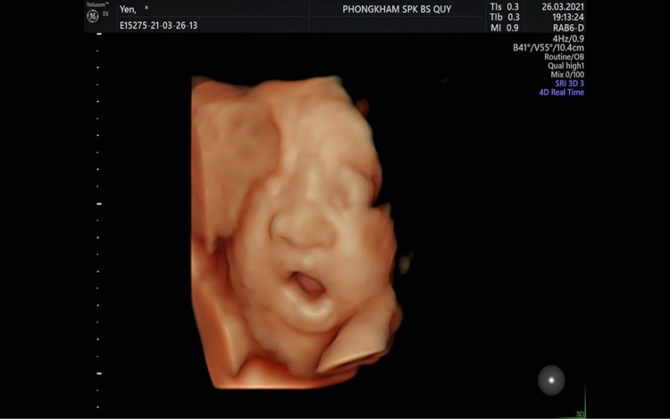 Trâu đực tháng 6 nè 
Các mom siêu âm có thấy con cười như vậy bao giờ chưa