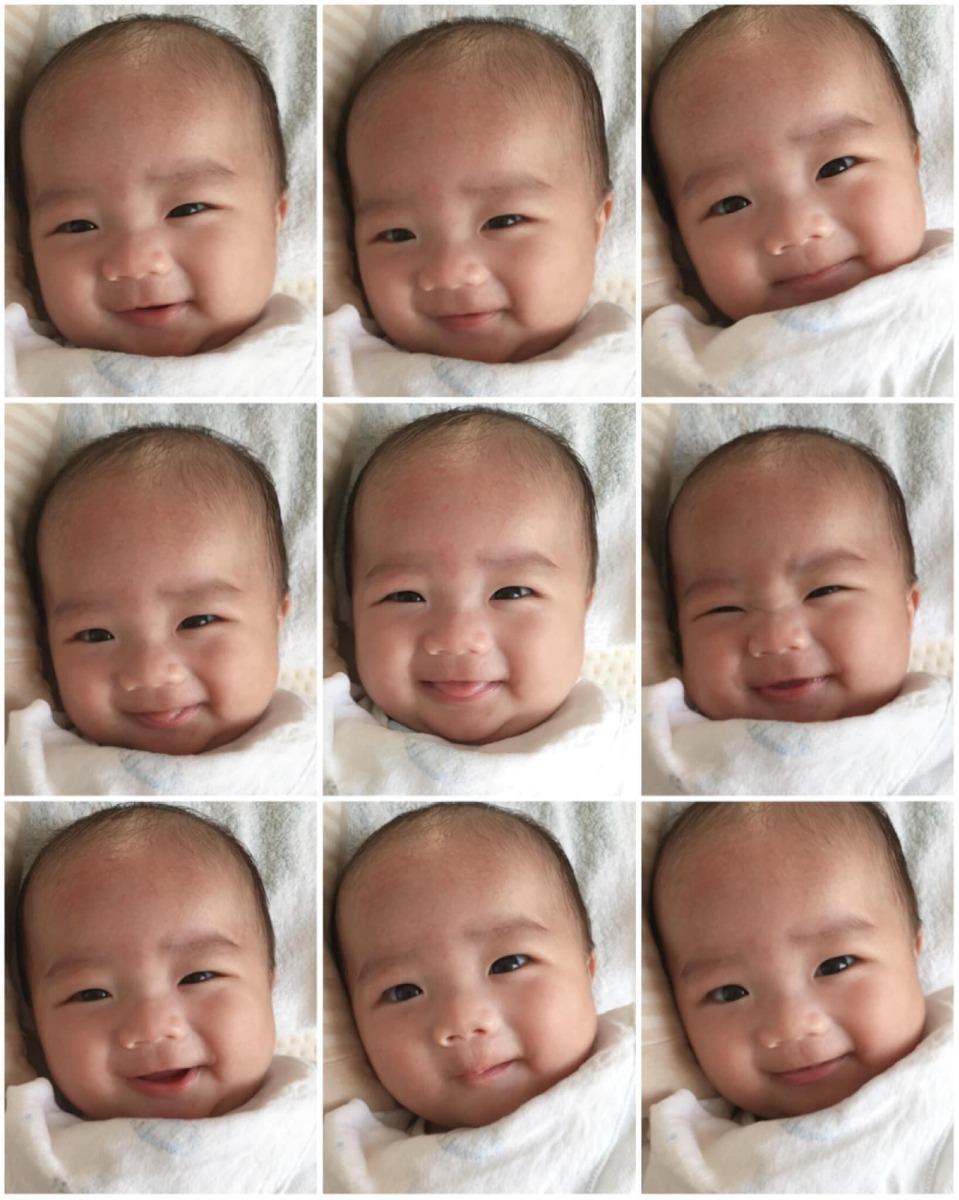 Tâm sự và chia sẻ về sinh non và sinh mổ ở Vinmec Times City Ha noi 
Em chỉ mới và định có một bé thôi mà vô group này làm em có động lực sinh thêm quá ạ ( truớc đây em rất muốn có nhiều bé nhưng do sinh mổ + sinh non lại thêm quá trình chăm bé khiến em thay đổi). Nhiều mẹ có 3 bé trở lên thực sự khiến em ngưỡng mộ và tò mò làm thế nào các mẹ có thể chăm nhiều con cùng lúc được thế? ( em 1 đứa đã chiếm hết thời gian của em rồi 😭 ) . Xin các mẹ chia sẻ và cho em xin kinh nghiệm với ạ? 
Còn đây là tâm sự của em về chuyện sinh non và sinh mổ ở Vinmec Times City Ha noi 
Cả thai kỳ em hoàn toàn khoẻ mạnh, hoạt động sinh hoạt như bình thường, ăn uống ngon miệng, đi du lịch, yoga, kiểm tra gặp bác sĩ theo lịch hẹn đầy đủ. 
Vậy mà, đến tuần 34 của thai kỳ em đi khám thai bác sĩ trưởng khoa Vinmec ( bs Nghĩa ) bác còn khen em và em bé phát triển rất tốt, em bé quay đầu, khung xương chậu phù hợp sinh thường còn bảo em kiểm soát cân nặng bé đừng để to quá khó sinh. Và ngay tối hôm ấy khoảng 10 giờ em vào toilet trước khi ngủ thì bỗng dưng nước xối xả chảy xuống, em hốt hoảng nghĩ thôi chết xong rồi ( vì em có đọc sách đuợc biết vỡ ối là chuẩn bị sinh ). Em bảo chồng xong gọi cho bác Nghĩa bác bảo vào viện luôn. Em có mang tả sau sinh. Và 2 vc gọi taxi vào viện, trên taxi em cảm giác nước cứ chảy xối xả. Đến viện em vô phòng cấp cứu có 2 bạn trực hỏi em các câu hỏi căn bản xong bảo chị y tá đưa lên phòng sinh 😲 e hốt hoảng bảo em chưa muốn sinh bây giờ, bạn ấy giải thích là vì thai 34 tuần nên ưu tiên cho bé trước nếu thai nhỏ thì mới ưu tiên mẹ.
Sau khi lên phòng sinh có chị bác sĩ Dung vào kiểm tra, làm các thủ xét nghiệm xong rồi thông báo là có thể em phải sinh luôn không giữ thai được ( lúc này em khóc em cứ nài nĩ là giữ thai thêm cho em được bao lâu hay bấy lâu vì thai em còn non quá ). Bs giải thích ối của em rách lỗ to rồi nên ối chảy ra hết nên không còn cách giữ thai. Bây giờ có hướng là tiêm trưởng thành phổi cho bé mà tiêm phải đủ 2 mũi cách nhau trong bao nhiêu tiếng em quên rồi thì mới có tác dụng mà tiêm mũi này cũng có xác xuất là tăng nhanh nguy cơ nhiễm trùng ( vỡ ối thì sẽ nhiễm trùng vô bào thai ). Vợ chồng cân nhắc và quyết định. Thật ra lúc này bác sĩ nói nhiều lắm mà về chuyên môn nên em không nhớ hết. Bên Vinmec có thông dịch viên nhưng vì tối nên chỉ gọi điện và dịch cho chồng em hiểu ( chồng em người nước ngoài ).
Đây là điều mà cá nhân em không thích nhất ở Vinmec là đưa thông tin rất nhiều và toàn thông tin chuyên môn nghiệp vụ cho thai phụ, người nhà rồi bảo mình quyết định mà k có lời khuyên của Bác sĩ ( cảm giác giống như là mình quyết định thì có gì mình chịu trách nhiệm ý mà mình thì có hiểu gì chuyên môn đâu cơ chứ ) 
Sau một hồi bàn bạc thì Vc em quyết định tiêm trưởng thành phổi cho bé. Cả đêm em khóc suốt không ngủ nỗi. Đến sáng thì có bác sĩ khác vào khám và chỉ định đi siêu âm, siêu âm là bác sĩ người Mỹ bác bảo hết sạch ối rồi, lúc đó em thấy bụng em nhỏ lại con em cử động ntn em đều thấy qua lớp da bụng hết ( trông sợ lắm ) , bác cũng an ủi là 34 tuần cũng không đến nỗi, bạn bác sinh non nhưng rất khoẻ mạnh và thông minh không có gì khác biệt đâu đừng lo. 
Ôi sao em thấy em viết dài dòng quá rồi nhỉ? Thôi chắc em viết tóm gọn lại tý chứ không kể chi tiết nữa sợ mọi người ngán đọc hihi
Vâng, vì đo monitor nhịp tim bé vẫn đập tốt nên bác sĩ vẫn chưa can thiệp gì, em tiêm được mũi truởng thành phổi thứ 2. Em không có cơn đau hay cơn gò nào cả.
Có một bác sĩ nam vào nói với em trước khi làm hồ sơ sinh ở viện là vì bé nguy cơ sinh non nên sau sinh phải ở lồng ấp thì chi phí là 3tr5/1 ngày chỉ là tiền phòng và các chi phí của thuốc, máy móc hỗ trợ nên ít nhất 6 triệu 1 ngày mà bé chưa sinh thì không biết bé ntn để có thể tính được sẽ nằm bao nhiêu ngày. Nhanh thì 5-6 ngày lâu có thể cả tháng hoặc hơn. Chi phí ở viện cao mà chị không có bảo hiểm, vậy chị có muốn chuyển qua viện công không? Nhưng Vc em vẫn quyết định sinh ở đây. 
Vì nguyện vọng của em là sinh thường nên cả ngày em vẫn chờ 1 cơn đau và mở thêm nhưng mãi chỉ 1 phân 🙄. Em có tiêm kích sinh nhưng cũng k đau k mở thêm. Tóm lại là sau khi chờ gần 70 tiếng thì em cũng bắt đầu có cơn gò và rất đau, đau quặng cả đêm đến sáng tầm 6h bác sĩ kiểm tra vẫn k mở và hội chuẩn xong rồi bảo em là giờ phải mổ cấp cứu nếu em không mổ em phải ký giấy miễn trừ trách nhiệm cho viện. 
Đương nhiên em đồng ý mổ vì con trong bụng quá lâu rồi. Nói thêm là bác sĩ có nói đi nói lại vì tim con em đập tốt và ổn định nên để lâu vậy chứ ca khác là mổ gấp rồi. 
Gây tê một phát ăn ngay, nhẹ nhàng không đau gì cả, ekip gây tê có trong phòng mổ cùng và trấn an em liên tục. Bác sĩ khoa Nhi cũng túc trực hỗ trợ, Bác sĩ Thái mổ chính cho em nói một câu với em khién em rất xúc động mặc dù chỉ là câu nói ngắn “ Phải mổ thôi con, không sao đâu con “ cảm giác như bác thấu hiểu tâm can em lúc đó vậy ý.
Rất nhanh sau đó tiếng con em khóc to lên , em thấy con em đem ra bàn cho bé lau hút, cân rồi quấn khăn đem đến cho em, bác sĩ nhi bảo là trộm vía các chỉ số bé đều ổn định, nặng 2kg03g nhưng vì sinh non nên bs phải đem về lồng ấp theo dõi thêm. Em ở lại khâu vết mổ sau đó về phòng hồi sức sau sinh.
Lúc ở phòng này em cứ sợ với cả chuẩn bị tâm lý hết thuốc tê sẽ đau lắm này nọ nhưng có 1 anh bác sĩ lại giới thiệu tên và nói là bác sĩ gây tê giảm đau cho em. Bs nói “ em yên tâm trước khi em cảm nhận được đau bên anh sẽ có cách để ức chế cơn đau của em, em sẽ không cảm thấy đau quá mức gì đâu, không phải sợ” Anh ấy tiêm vào 1 hay 2 bên đùi em cũng k nhớ rõ lắm.  
Rồi em về phòng, những ngày sau đó em hồi phục theo trình tự và không hề có cảm giác đau đớn nào. Cảm thấy thoải mái thư giản vì được nghĩ ngơi, phục vụ và ăn ngon. 
Riêng về phần con em thì bé tự thở, có thể bú bình mà không cần nhờ máy móc nhưng bé bị nhiễm trùng vì vỡ ối lâu nên phải vào thuốc. Và chiếu đèn trị vàng da. 
Em vào thăm con em khóc rất nhiều vì em thấy con bé quá, bé như con mèo ý, cảm giác như xương và da không thôi sợ lắm, cảm thấy tội nghiệp và có lỗi với con. 
Đến giờ em cũng không biết nguyên nhân vì sao lại sinh non mà không hề có dấu hiệu hay cảnh báo nào trước như vậy. Em hỏi bác sĩ cũng nói k biết được lý do chính xác vì vỡ ối non có rất nhiều nguyên nhân 😞 
Tổng kết là em và bé ở Vinmec 5 ngày sau sinh và truớc đó là 72 tiếng chờ sinh. Chi phí mổ đẻ lần 1, sàng lọc sau sinh, chi phí của bé tất cả khoảng hơn 80 triệu. 
Điều em không hài lòng ở Vinmec là như em có kể ở phần đầu rồi và cả thêm là bé em nằm phòng 3tr5 1 ngày là được 1 phòng cho người nhà bên khoa nhi mà không thông báo em biết để em nhận phòng cho mẹ và dì em từ Sài gòn ra ở. 
Còn tất cả về bác sĩ, y tá, dịch vụ chăm sóc , cơ sở vật chất ở bệnh viện em rất rất hài lòng và cảm thấy quyết định đúng đắn khi chọn sinh ở đây lẫn biết ơn đội ngũ y bác sĩ nhiều lắm. 
Cho em kể thêm là chị y tá trực phòng em lúc truớc mổ có nói bác sĩ Thái mổ cho em là nguời có kinh nghiệm hơn 30 năm và là truởng khoa đẻ bv phụ sản trung uơng nên em yên tâm, cả người nhà em bên ngoài có gặp người nhà của thai phụ khác và họ đều nói bác sĩ là nổi tiếng mát tay và đặt lịch hẹn bác mổ cho vì bác chỉ làm thứ 7 ở Vinmec thôi. Làm em cảm thấy thật may mắn ý. 
Con em trộm vía rất dễ nuôi hay cười, không khóc dai, khoẻ mạnh và các cột mốc phát triển ngang với bé đủ ngày đủ tháng, không biết có phải do vía bác đỡ bé ra không nữa ạ hihi
Tâm sự chia sẻ của em dài quá rồi. Cám ơn các mẹ đã đọc ạ.