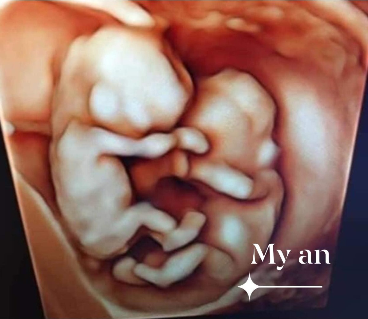 E Sắp hoàn thành nhiệm vụ rồi các mom ah
1 bạn trâu đực và 1 bạn trâu cái😅
Em  34w rồi ạ. Mỗi bé được 2500g và 2655g 
Bsi bảo trộm vía thai đôi mà to hơn cả thai 1🥰
Tặng vía  cho các mẹ nè