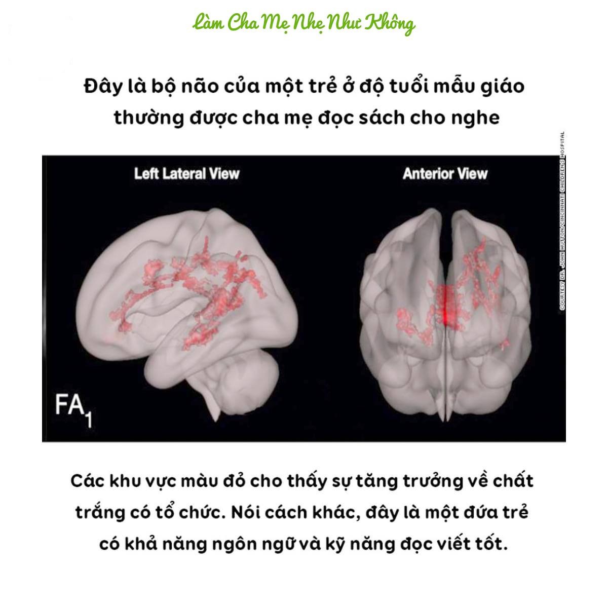 SỰ KHÁC BIỆT VỀ HÌNH ẢNH QUÉT NÃO BỘ CỦA MỘT ĐỨA TRẺ HAM ĐỌC SÁCH VÀ MỘT ĐỨA TRẺ THÍCH CHƠI ĐIỆN THOẠI

👉 Phụ huynh, xin đừng khiến tương lai của con mình khó khăn!

Nhiều bậc cha mẹ hiện nay vì công việc quá bận rộn nên không chú ý nhiều đến "việc chơi" của trẻ, không ít phụ huynh đã thoải mái "ném" cho con một chiếc Ipad hay điện thoại thông minh để con xem tránh làm phiền cha mẹ làm việc. Tuy nhiên, họ lại không biết đó chính là một trong những cách kìm hãm sự phát triển não bộ của trẻ nhỏ trong 5 năm đầu đời.

Một trong những biện pháp tốt nhất để phát triển trí não một đứa trẻ dưới 5 tuổi là đọc sách cho chúng nghe và tránh để con tiếp xúc nhiều với điện thoại thông minh. Người lớn chúng ta đều biết đó là điều đúng đắn nên làm nhưng với những hình ảnh được đưa ra từ khoa học này, chắc chắn chúng ta còn càng bị thuyết phục hơn.

👉 Trong hình ảnh quét não bộ của một trẻ mẫu giáo thường xuyên được bố mẹ đọc sách cho nghe, các khu vực màu đỏ cho thấy sự tăng trưởng về chất trắng có tổ chức chứng tỏ đứa bé này có khả năng ngôn ngữ và khả năng đọc viết tốt, hỗ trợ rất nhiều cho việc học ở trường sau này.

👉 Trong hình ảnh quét não bộ của một trẻ bộ não của một trẻ mẫu giáo thường xuyên dành 2 giờ mỗi ngày để xem điện thoại. Các khu vực màu xanh cho thấy sự kém phát triển và vô tổ chức của chất trắng, tức là đứa trẻ này sẽ gặp khó khăn trong việc học sau này.
Cả hai kết quả nghiên cứu đều sử dụng thông qua phương pháp chụp cộng hưởng từ (MRIs) đặc biệt bằng cách kéo căng khuếch tán hình ảnh. Trong nghiên cứu này đã có 47 trẻ dưới 3 tuổi, chưa đi học mẫu giáo, có thể chất khoẻ mạnh tham gia.

Việc tăng và tổ chức chất trắng rất quan trọng đối với khả năng giao tiếp của một đứa trẻ. Nếu không có một hệ thống giao tiếp phát triển tốt, tốc độ xử lý của não sẽ chậm lại và việc học của trẻ bị ảnh hưởng ít nhiều.

Ngoài việc quét não, những đứa trẻ tham gia vào nghiên cứu cũng được kiểm tra nhận thức. Các nhà nghiên cứu chỉ ra những đứa trẻ sử dụng màn hình hơn 1 giờ mỗi ngày có kỹ năng đọc viết kém hơn, khả năng sử dụng ngôn ngữ biểu cảm ít hơn và khả năng gọi tên các đối tượng thấp hơn. Ngược lại, những đứa trẻ thường xuyên đọc sách với bố mẹ đạt điểm cao hơn trong các bài kiểm tra nhận thức.

"Chúng tôi thấy được những mặt không tốt từ việc xem điện thoại thường xuyên lên một đứa trẻ, cụ thể là ảnh hưởng đến khả năng ngôn ngữ, đọc hiểu của trẻ. Mặt khác, những hoạt động có lợi cho các phần khác nhau của não bộ, kích thích trí tưởng tượng như chơi đồ chơi, đi ra ngoài khám phá thiên nhiên sẽ phù hợp với một trẻ mẫu giáo hơn là ngồi trước màn hình điện thoại", Tiến sĩ Hutton - bác sĩ Nhi khoa & Nhà nghiên cứu lâm sàng tại Bệnh viện Trẻ em Cincinnati bày tỏ.

-----------------------

Đọc sách cho con như thế nào mới tốt?

Tiến sĩ Hutton cho biết nhiều phụ huynh loay hoay và áp lực đi tìm một cuốn sách hoàn hảo để đọc cho con. Nhưng thực tế, chẳng có cách đọc nào tốt nhất cả. Hãy đọc sách cho con với một tình yêu thương bao la và sự kiên nhẫn của một bậc làm cha làm mẹ cần phải có.
Dưới đây là một số lời khuyên dành cho các bậc phu huynh để thu hút và lôi kéo con bạn yêu thích sách và đọc sách nhiều hơn:

✔ Thường xuyên trò chuyện với con.
✔ Hát những bài hát thiếu nhi.
✔ Cho con được thoả trí tưởng tượng sáng tạo những câu chuyện của riêng mình và sau đó, cha mẹ nên đặt nhiều câu hỏi về cốt truyện để kích thích con tiếp tục tưởng tượng.
✔ Cha mẹ nên chọn đọc những cuốn sách có nhân vật thú vị và đừng ngại nhập vai hay biểu cảm bằng các giọng đọc khác nhau dành riêng cho mỗi nhân vật.
✔ Cho con chỉ vào tranh hoặc từ rồi lặp đi lặp lại từ đó.

Điều cuối cùng và quan trọng nhất: Bố mẹ nên thư giãn chính mình để giáo dục con tốt hơn!